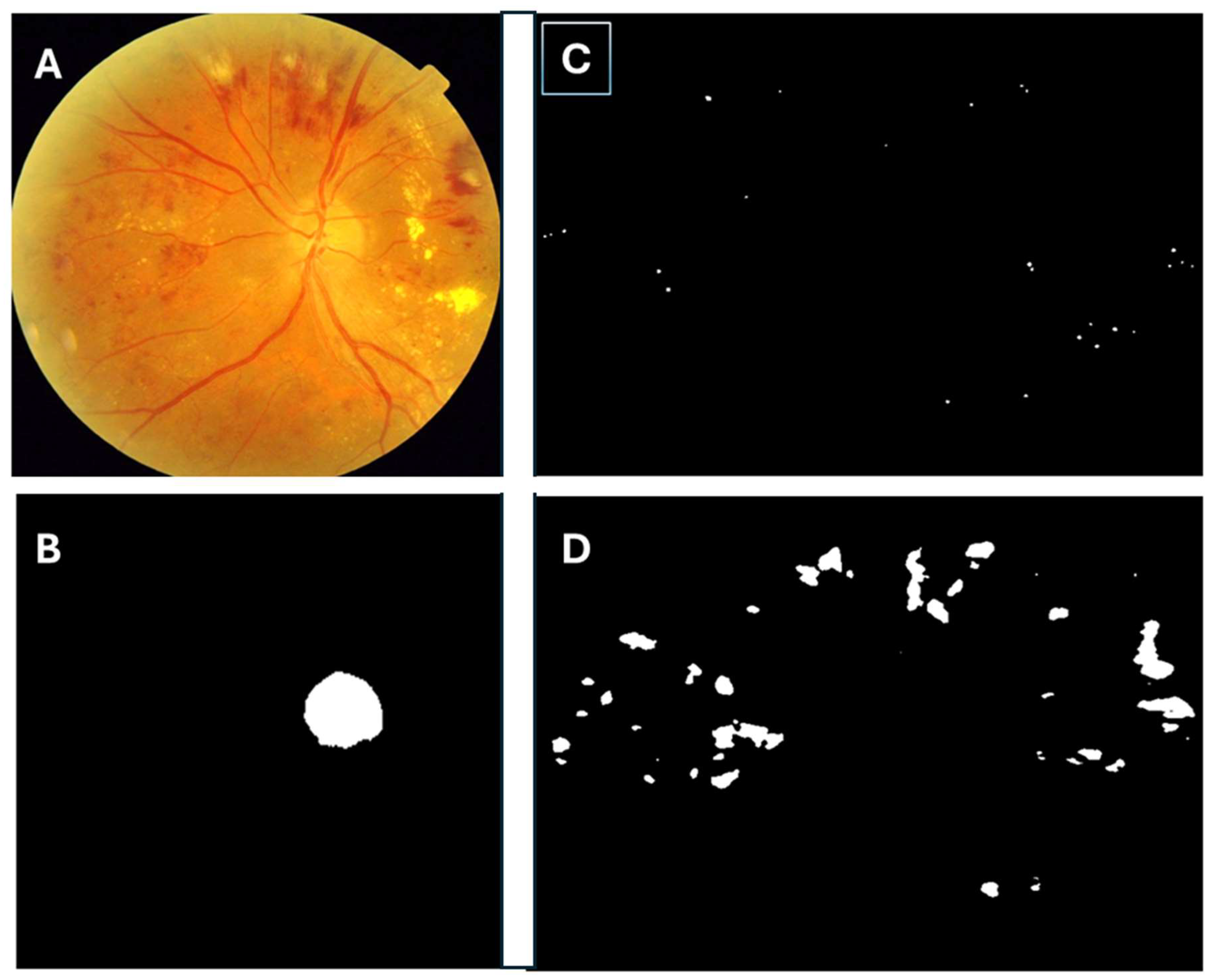 Diagnostics | Free Full-Text | Distribution of Microaneurysms and ...