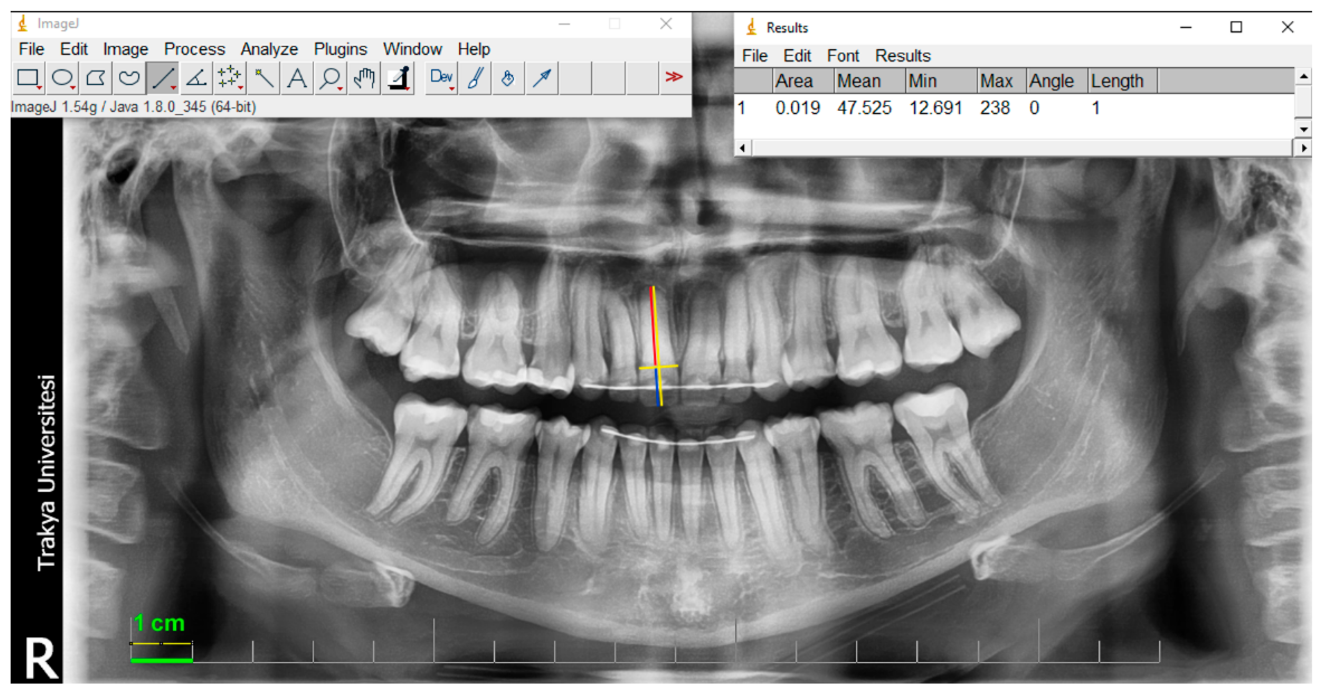 Evaluation of External Apical Root Resorption in Cases with Extraction ...