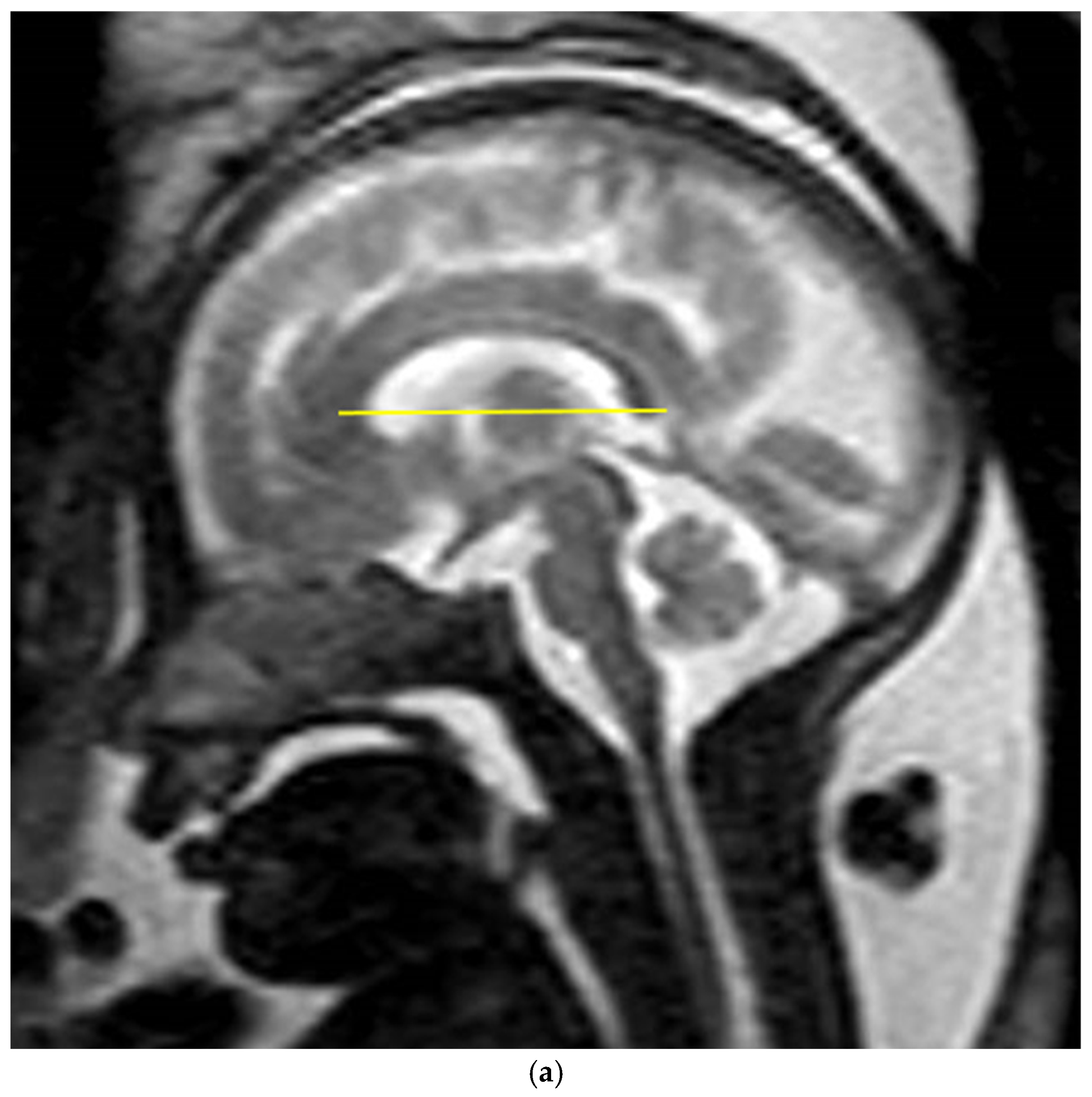 Assessing the Agreement Between Diffusion Tension Imaging (DTI) and T2 ...