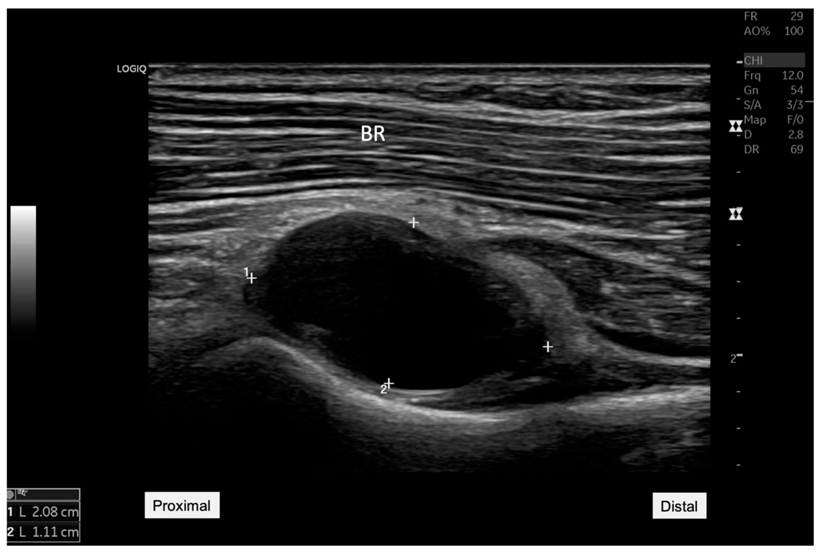 A Rare Case of Elbow Synovial Cyst with Radial Nerve Compression