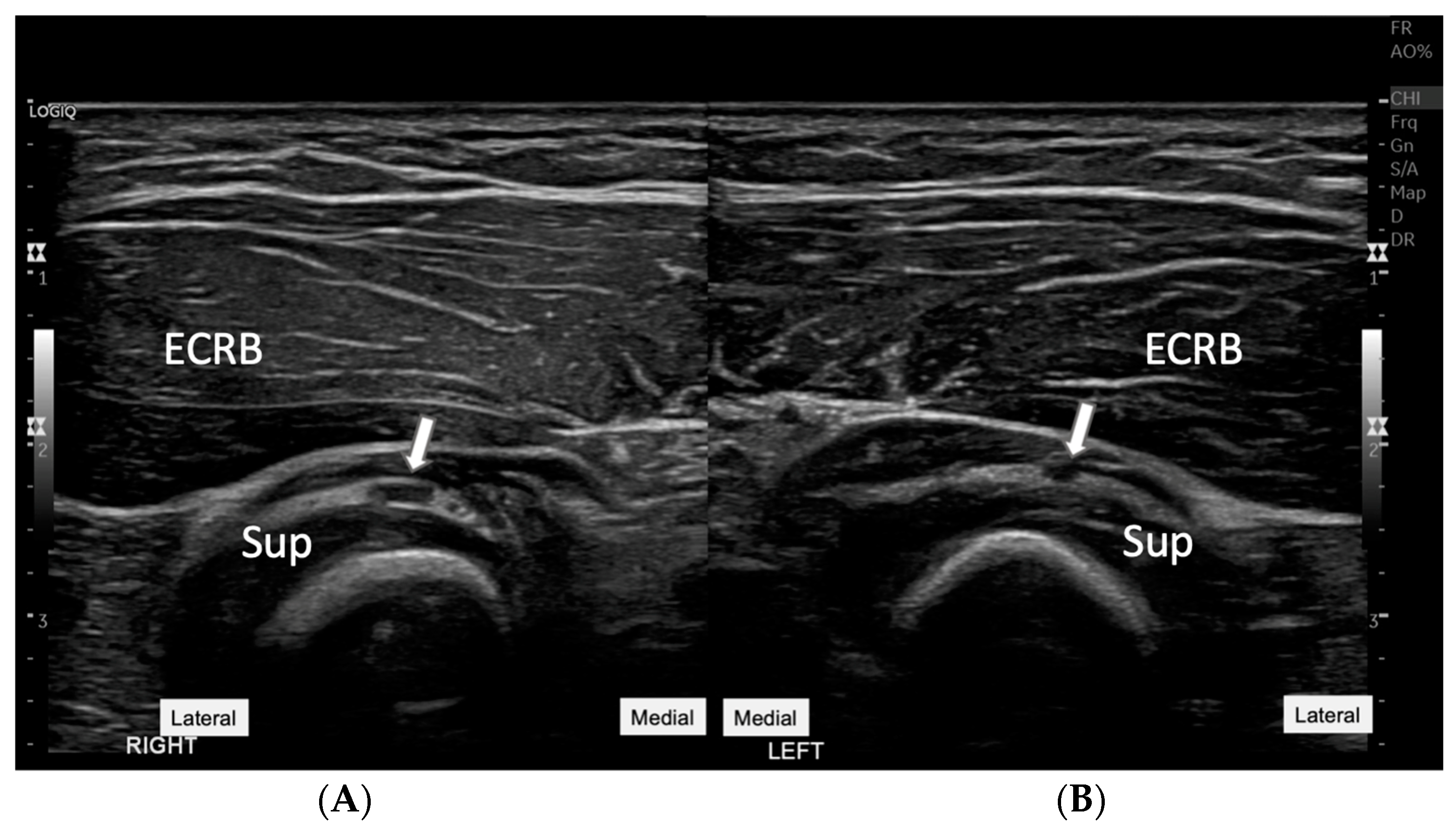 A Rare Case of Elbow Synovial Cyst with Radial Nerve Compression