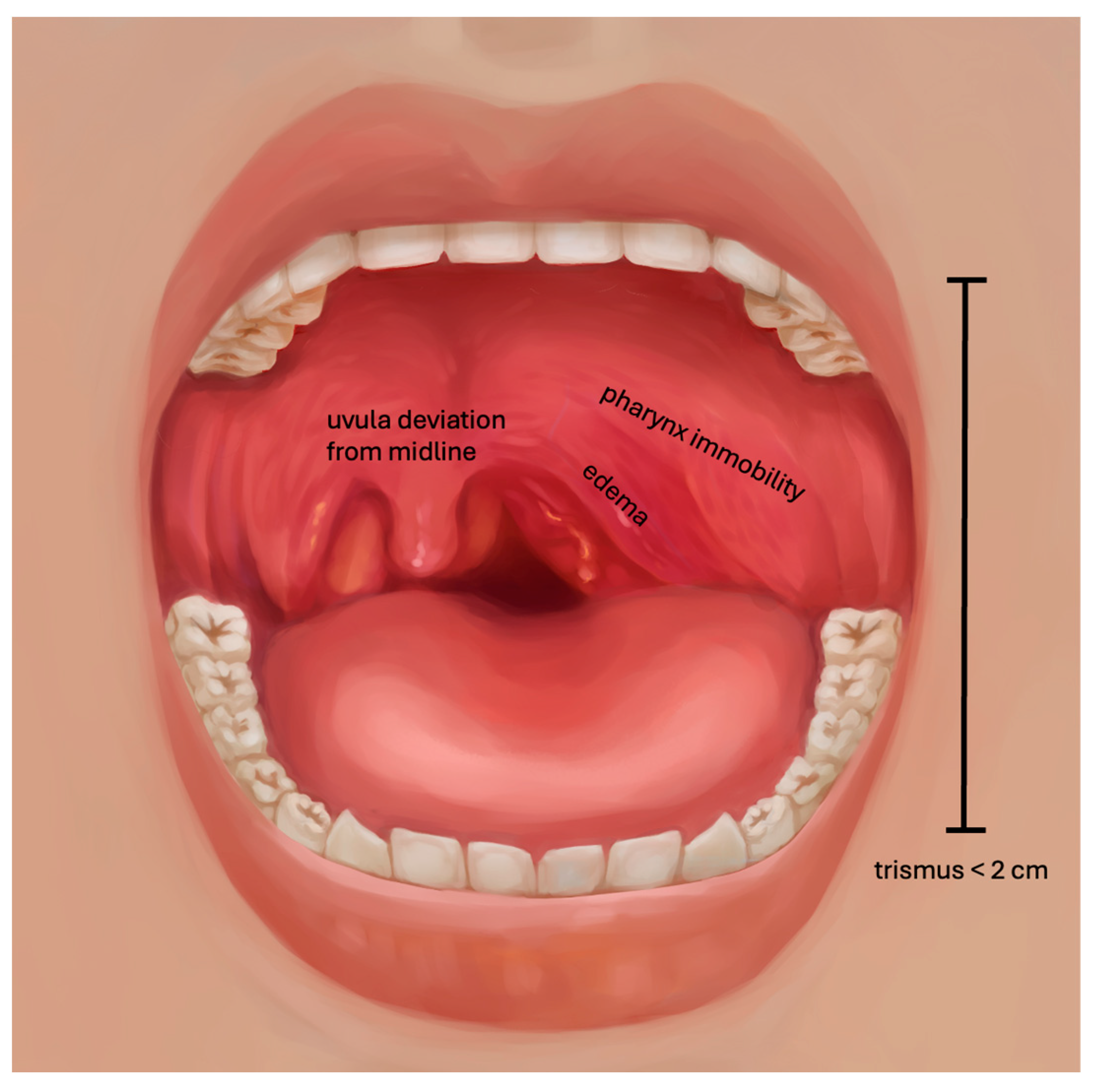 Peritonsillar Abscess Score Peritonsillar Abscess Score