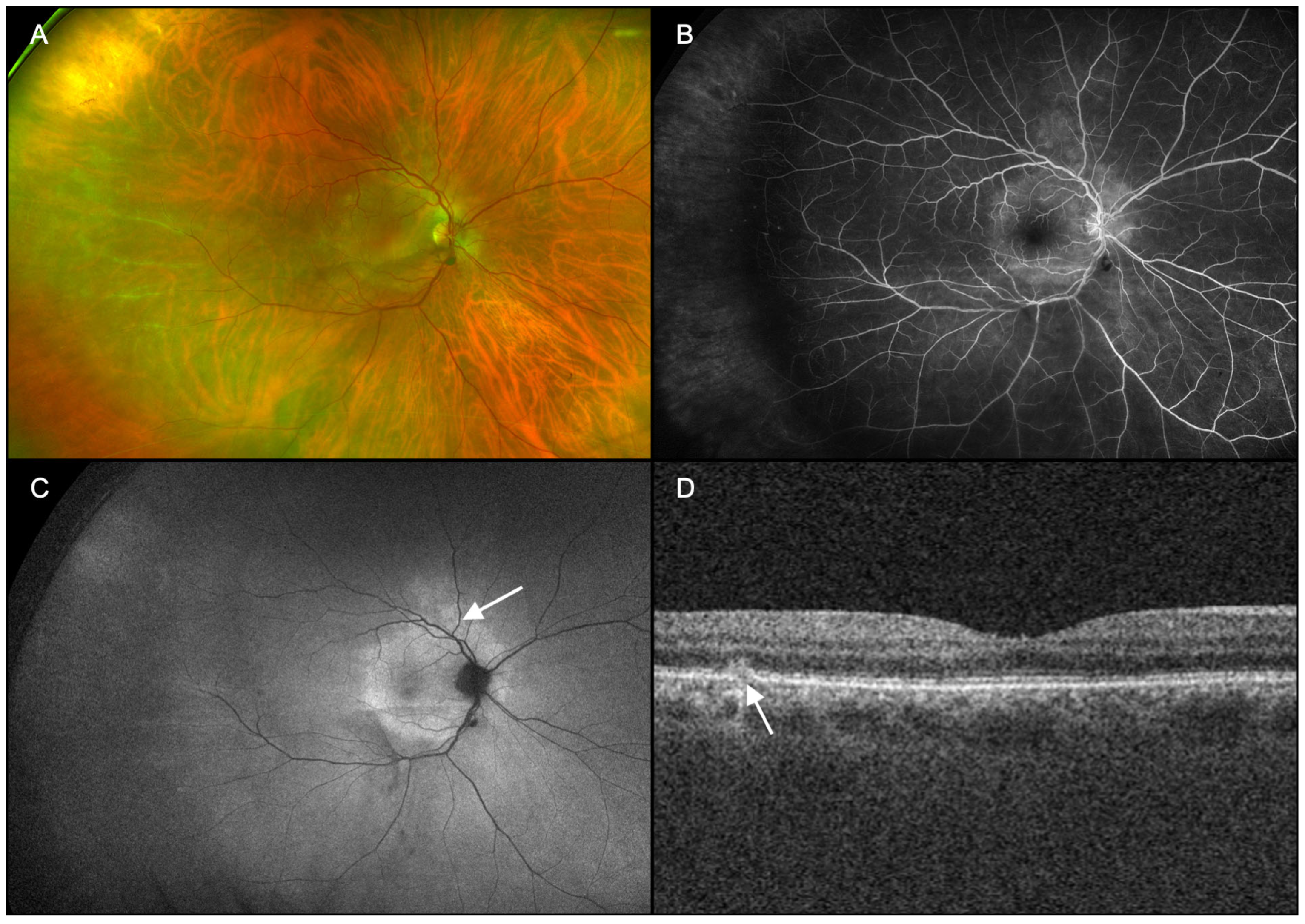 Characterization Of Syphilitic Chorioretinitis As A White Dot Syndrome Characterization Of Syphilitic Chorioretinitis As A White Dot Syndrome