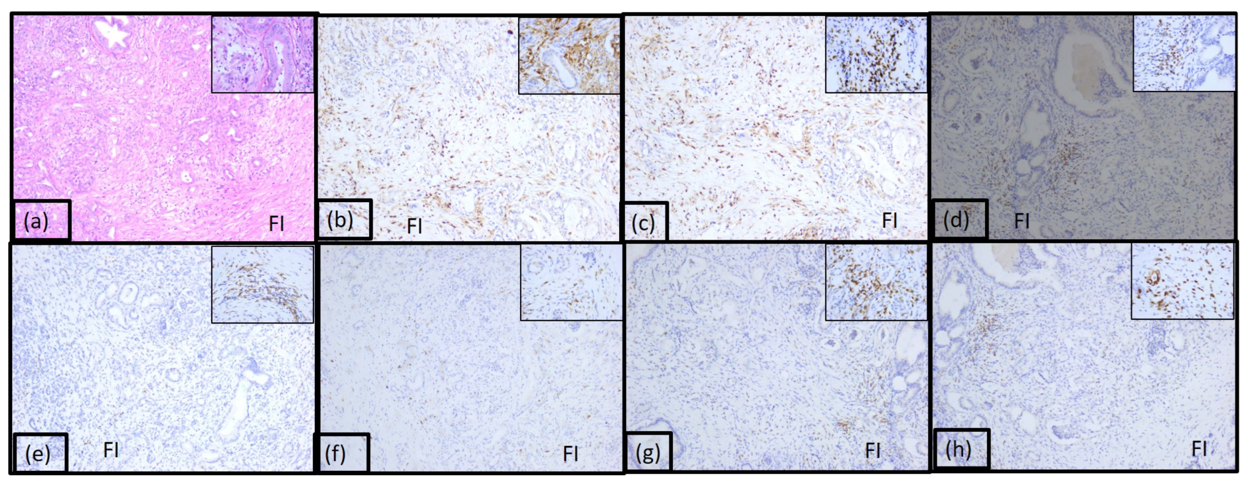 Immunohistochemical Evaluation of the Tumor Immune Microenvironment in ...