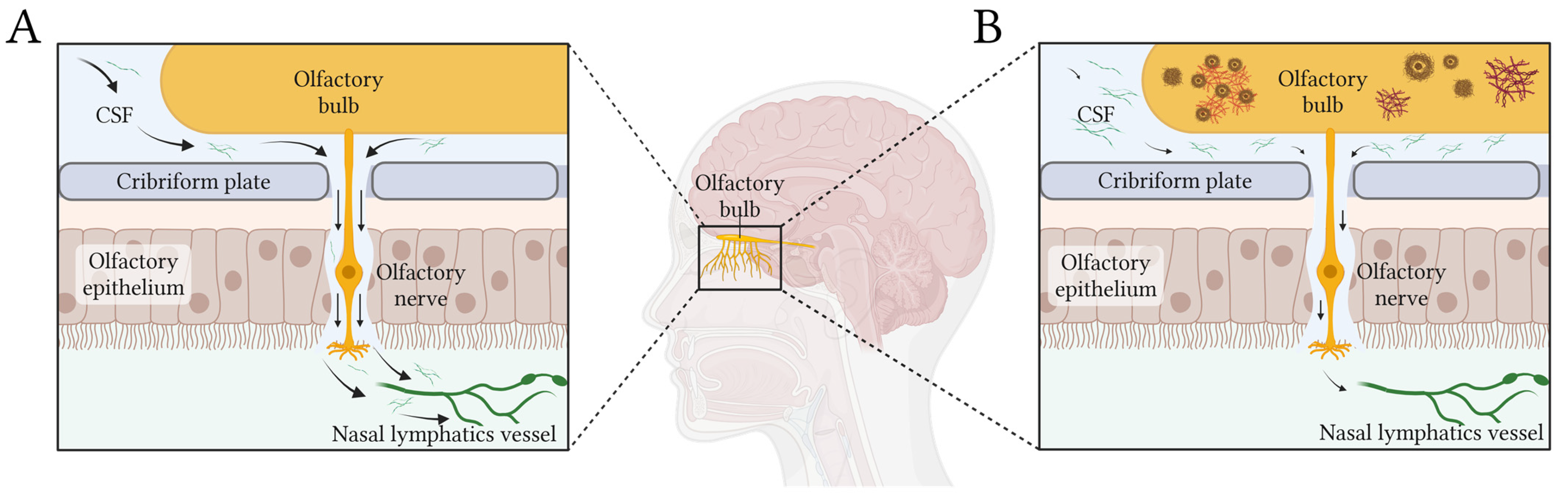 Olfactory Dysfunction as a Clinical Marker of Early Glymphatic Failure ...