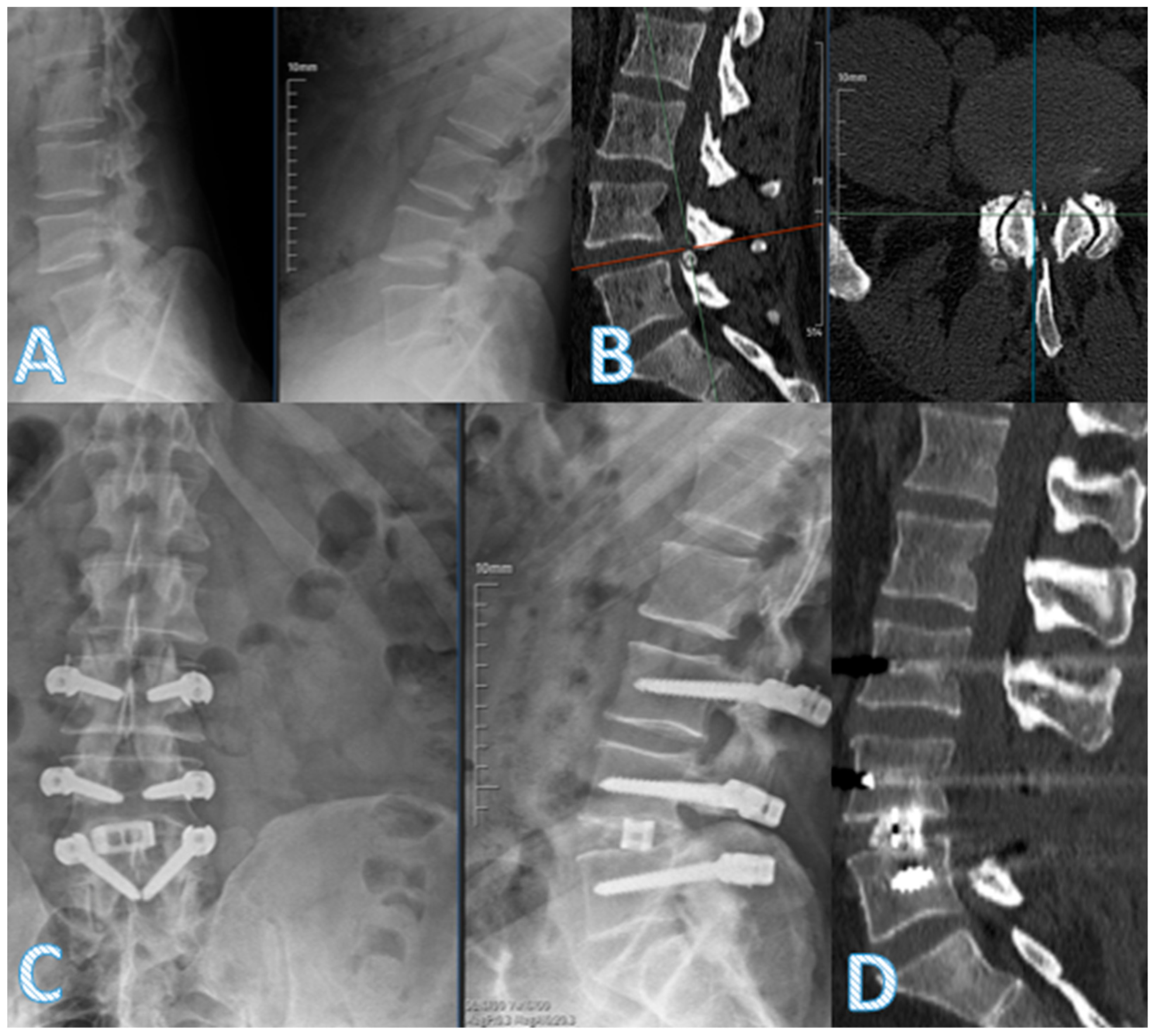 Comparison of Hybrid Dynamic Stabilization with TLIF Versus Dynamic ...