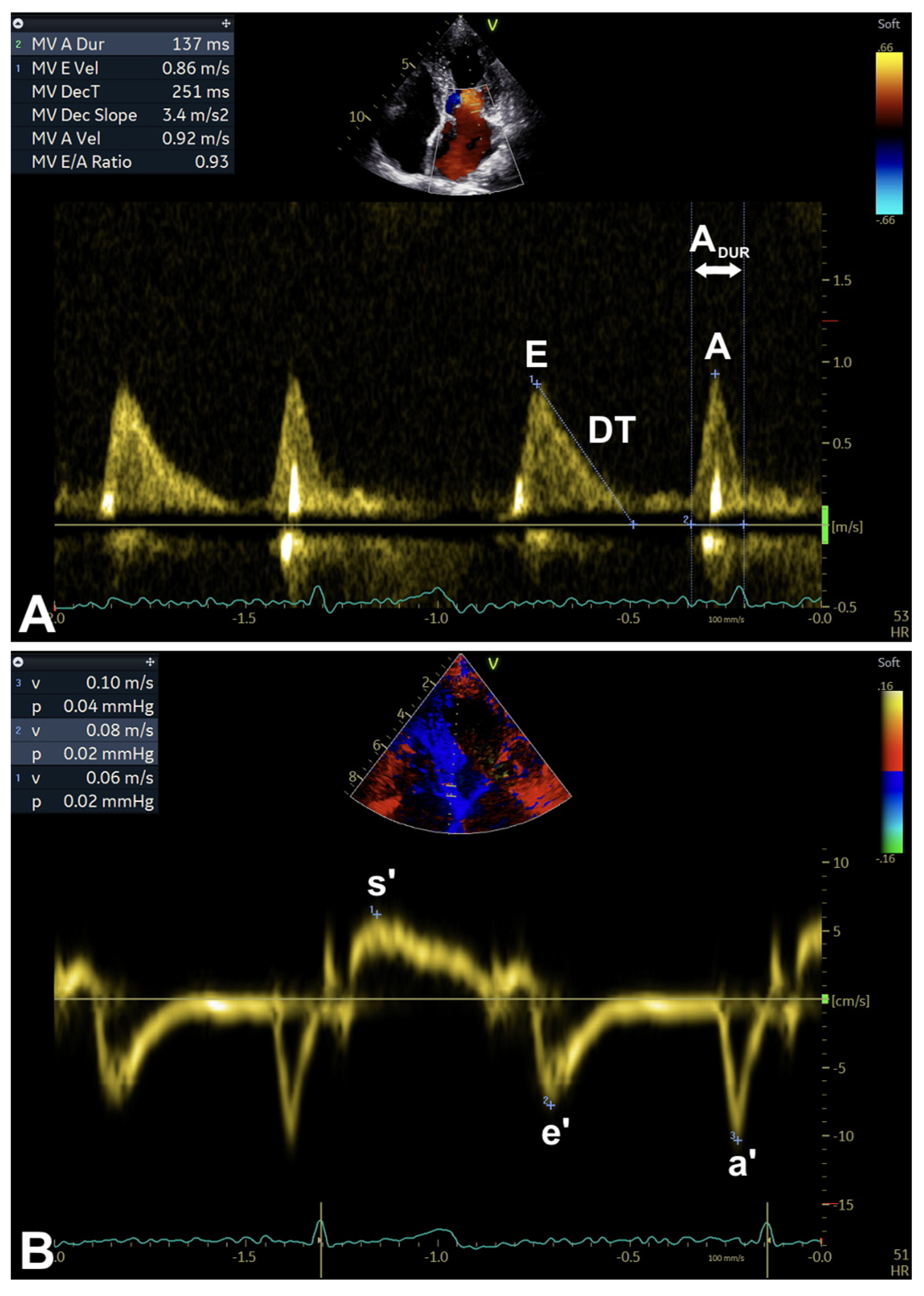 Echocardiographic Assessment of Left Ventricular Diastolic Function in ...