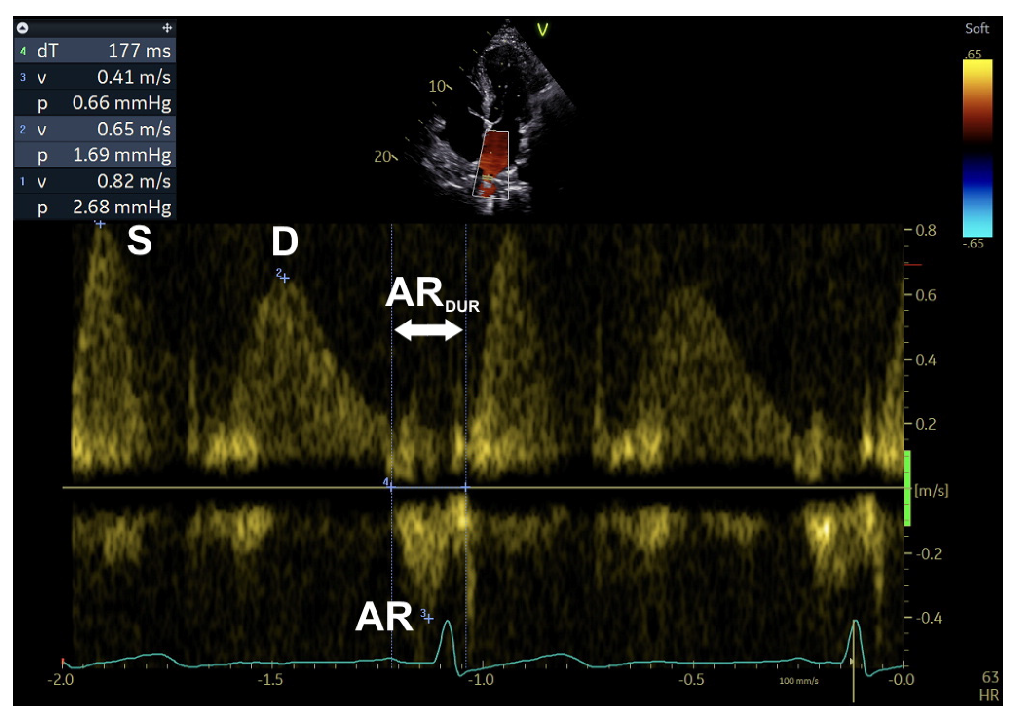Echocardiographic Assessment of Left Ventricular Diastolic Function in ...
