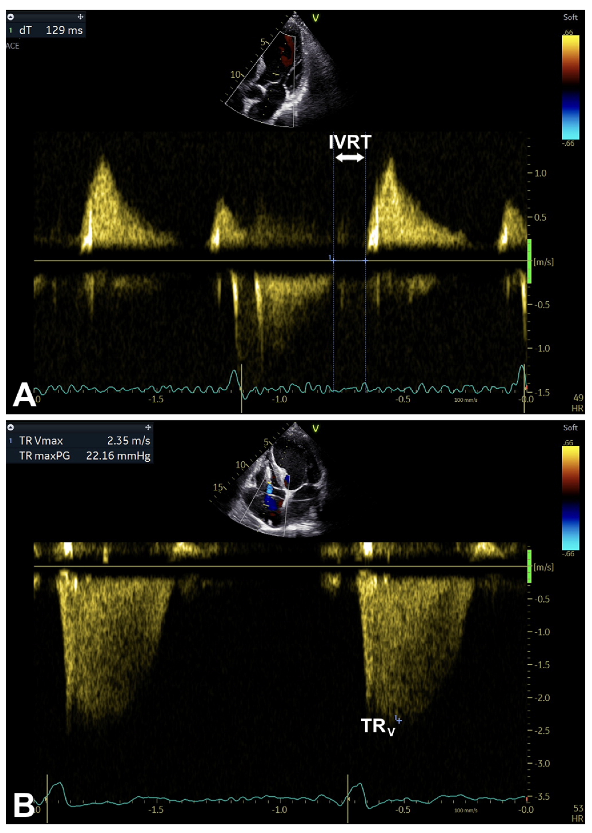 Echocardiographic Assessment of Left Ventricular Diastolic Function in ...