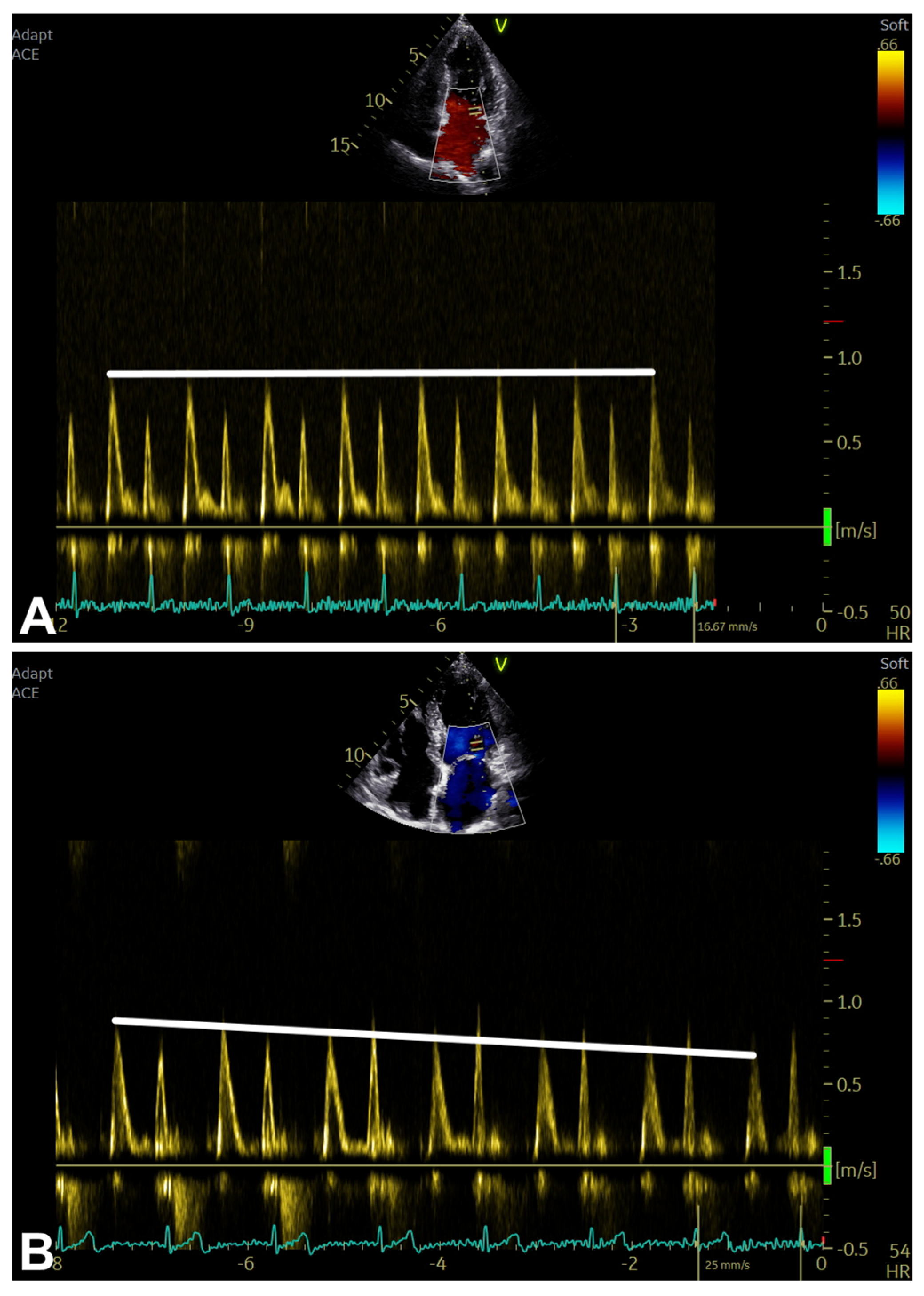 Echocardiographic Assessment of Left Ventricular Diastolic Function in ...