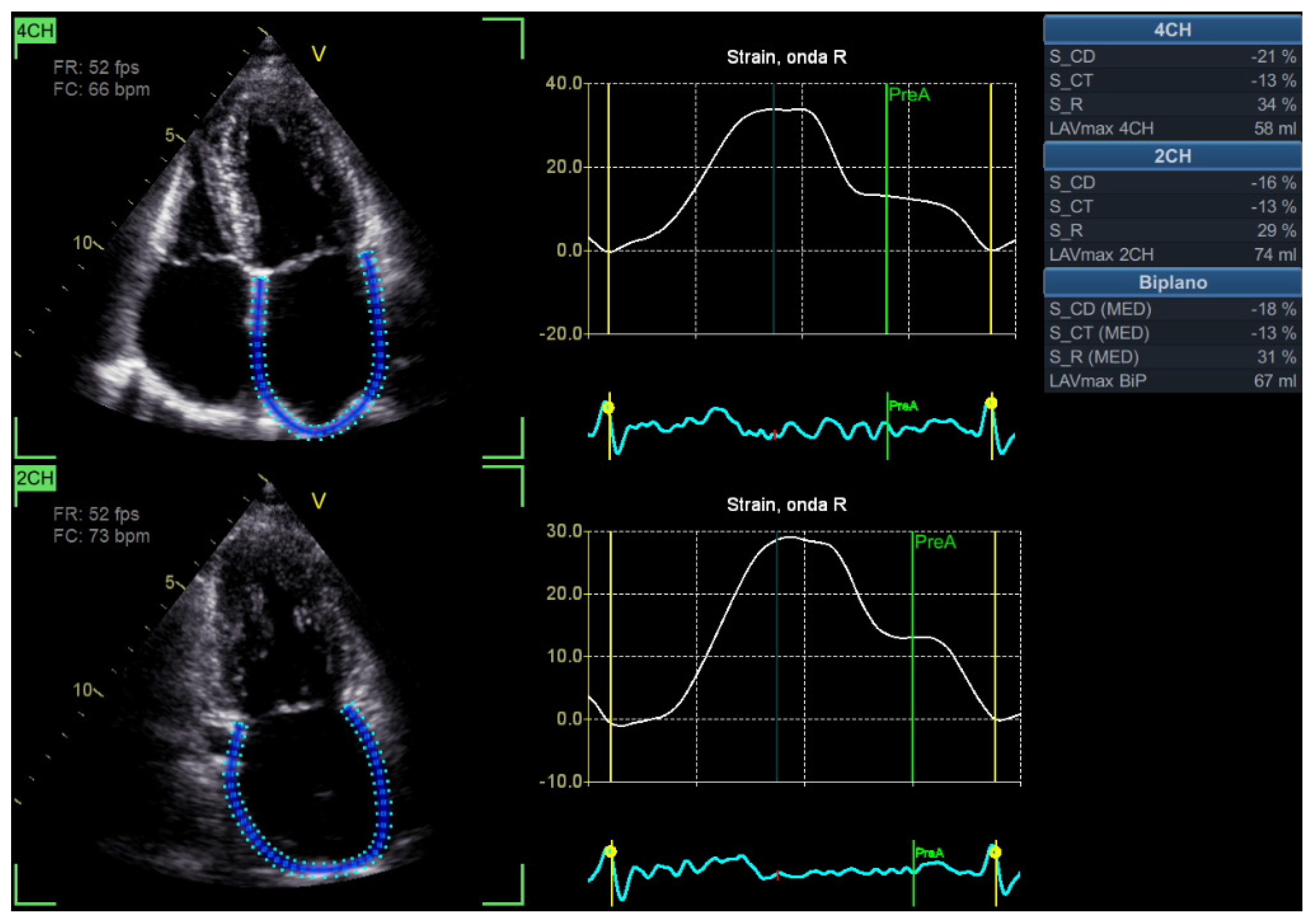 Echocardiographic Assessment of Left Ventricular Diastolic Function in ...