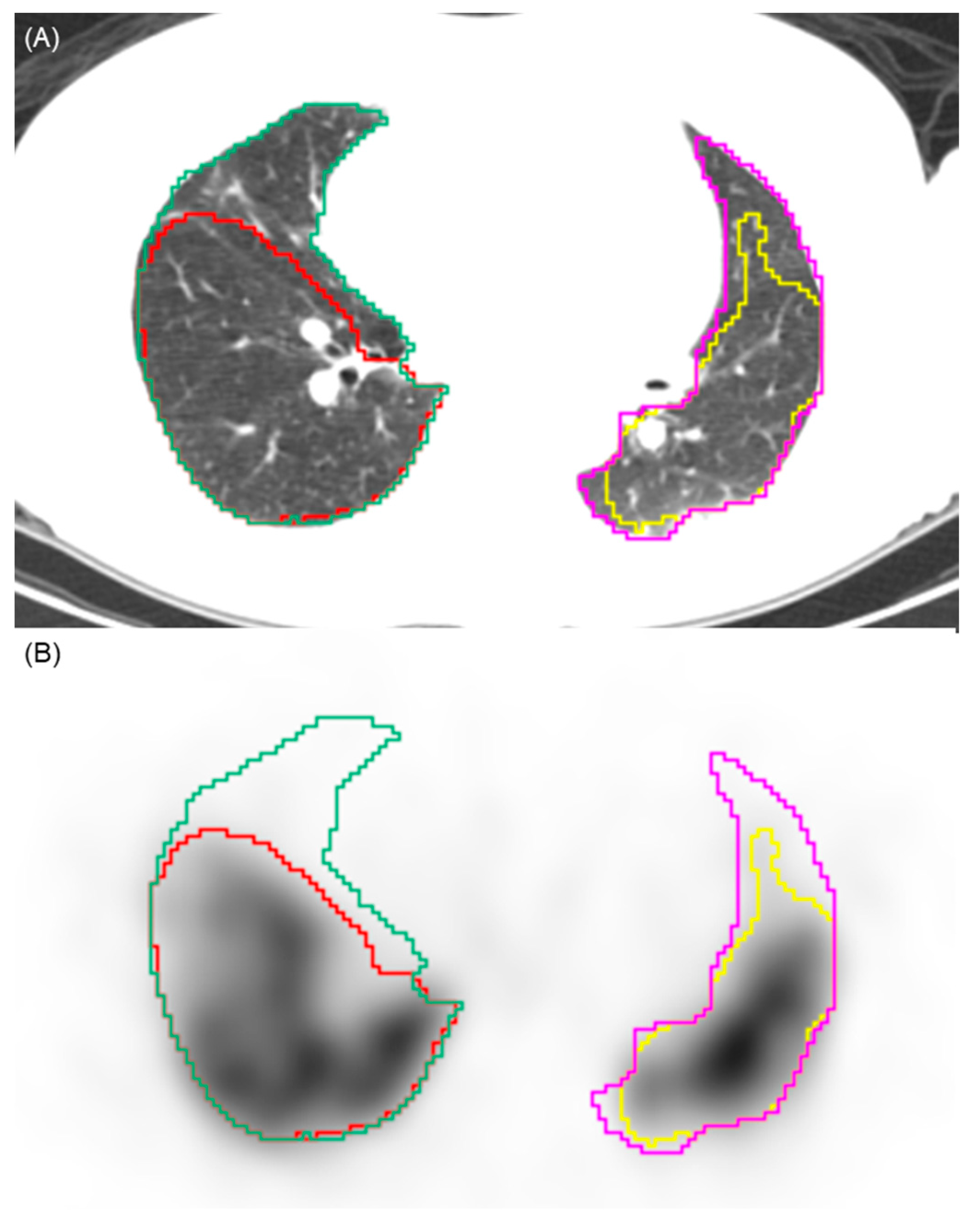 Diagnostic Performance of Quantitative Lung Perfusion SPECT/CT for ...