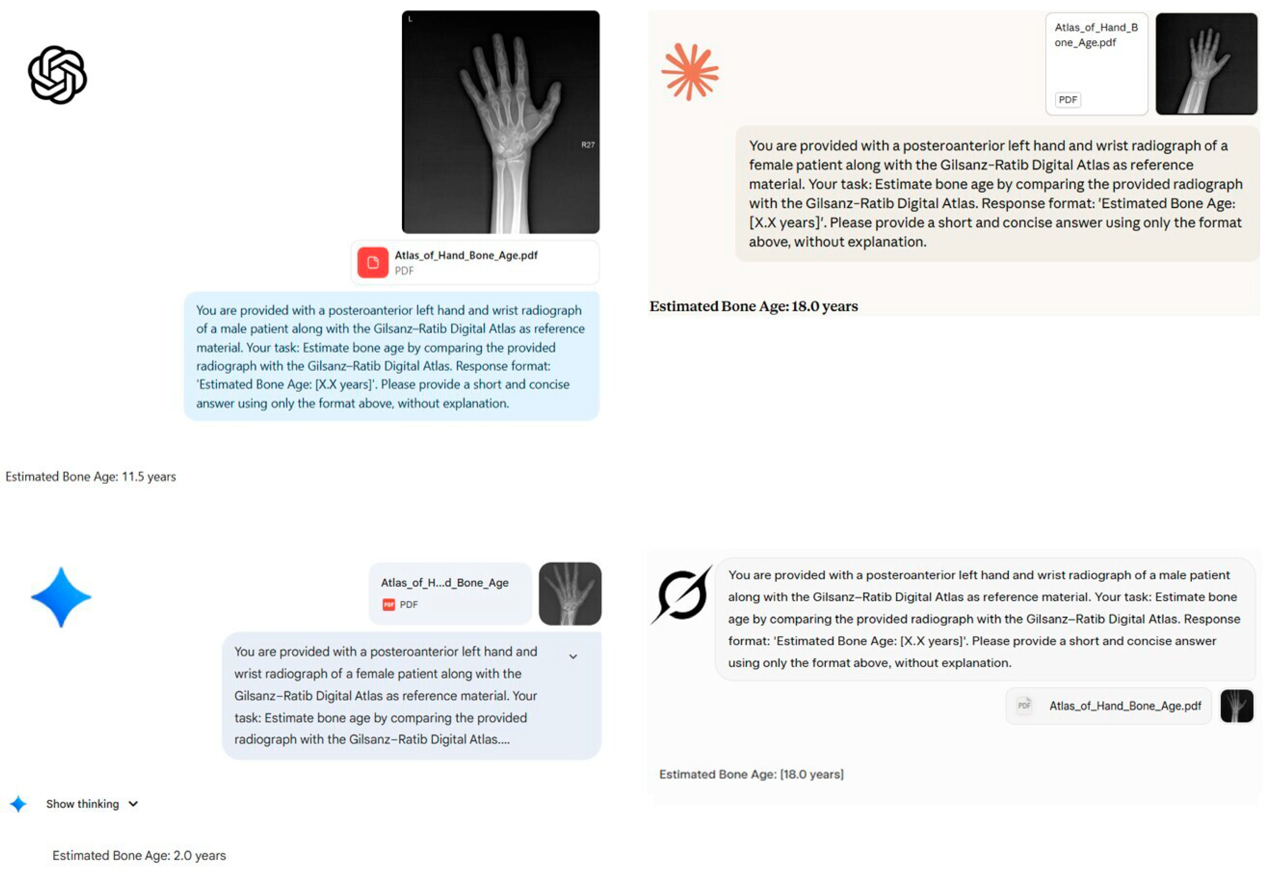 Atlas-Assisted Bone Age Estimation from Hand–Wrist Radiographs Using ...