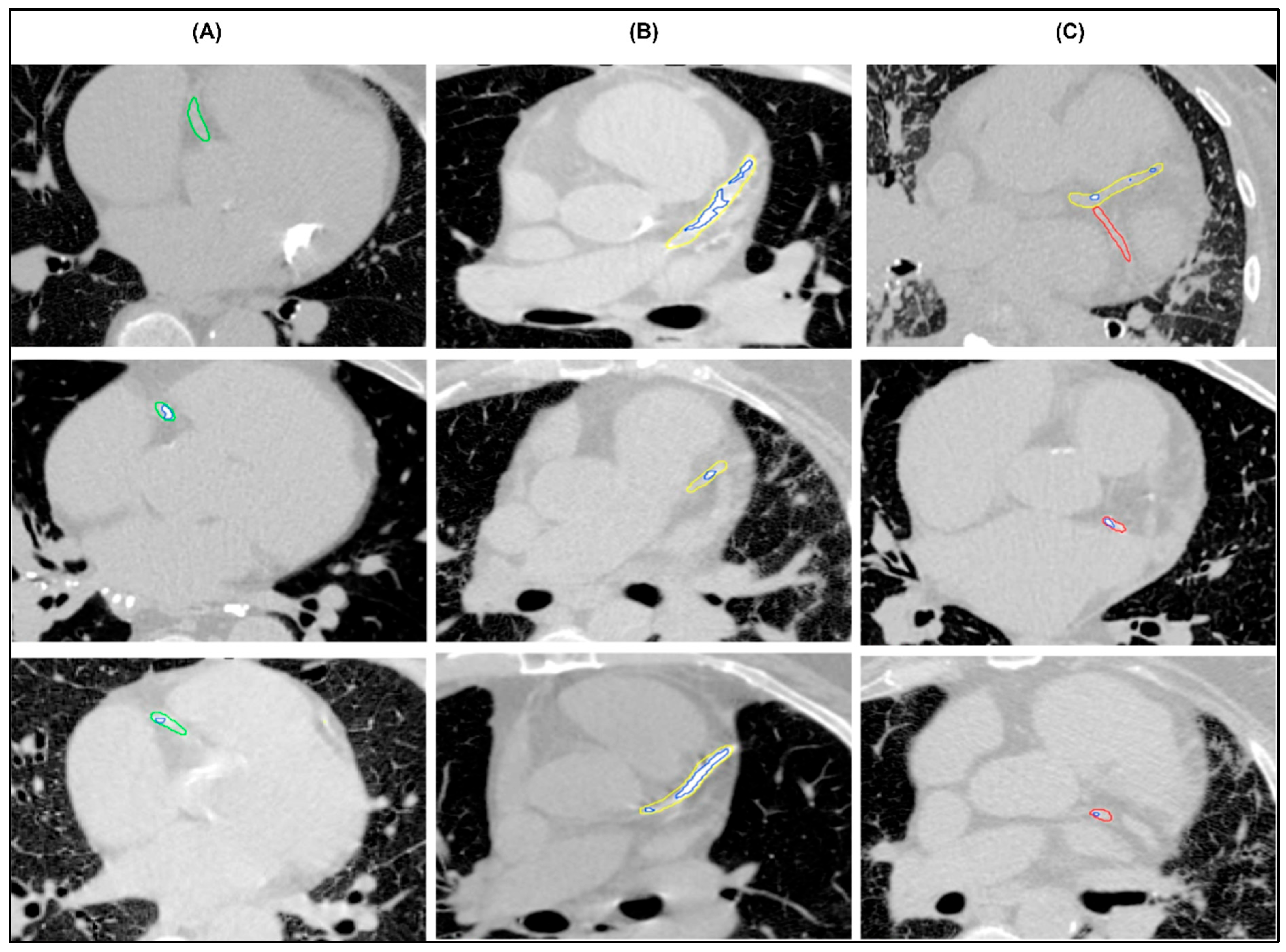 A Novel Fully Automated Deep Learning Model for Coronary Artery ...