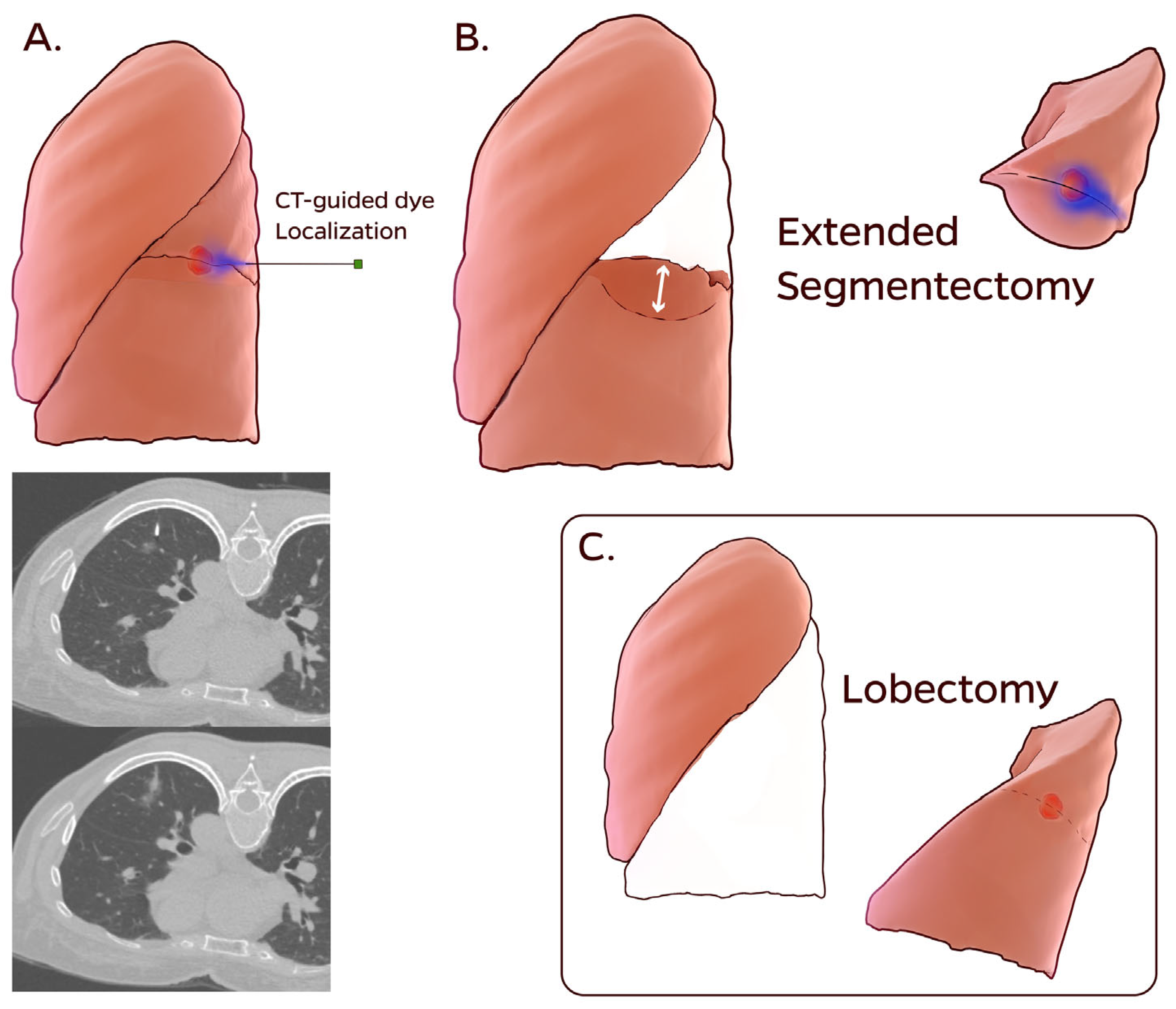 Dye Localization Extended Segmentectomy vs. Lobectomy for Deep ...