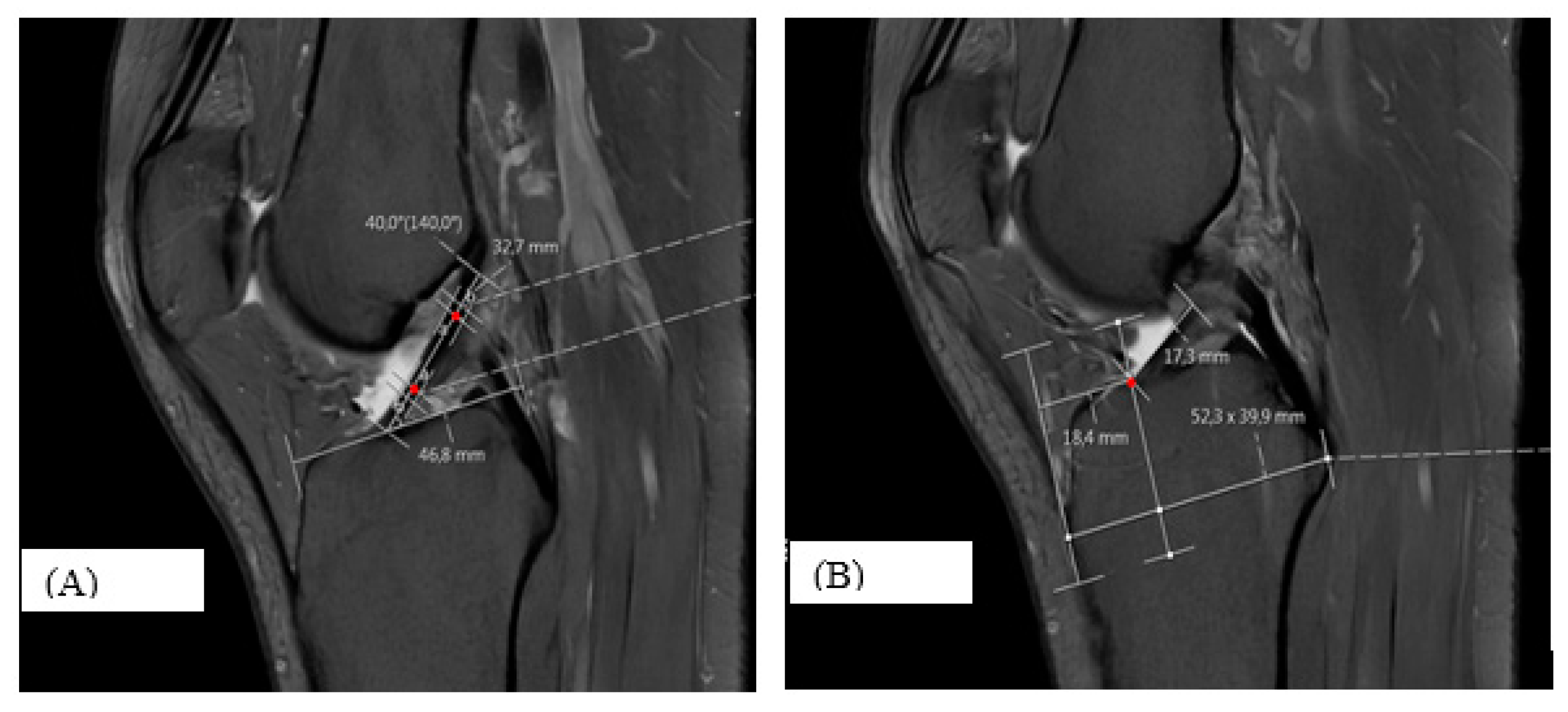 Morphometric Evaluation of Anterior Cruciate Ligament Orientation and ...
