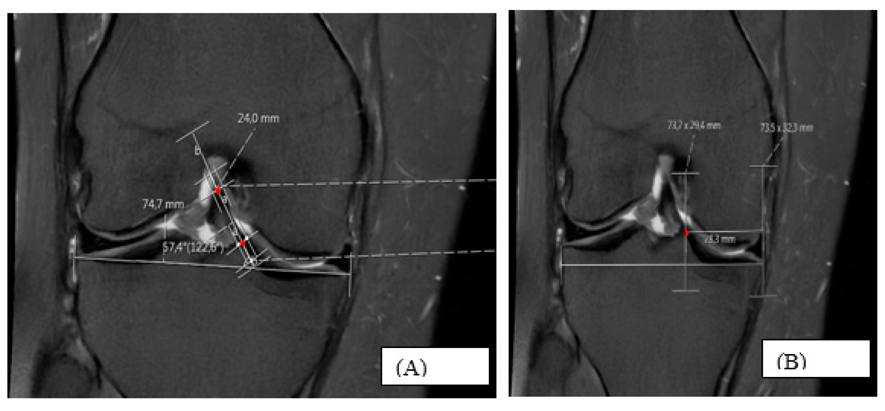 Morphometric Evaluation of Anterior Cruciate Ligament Orientation and ...