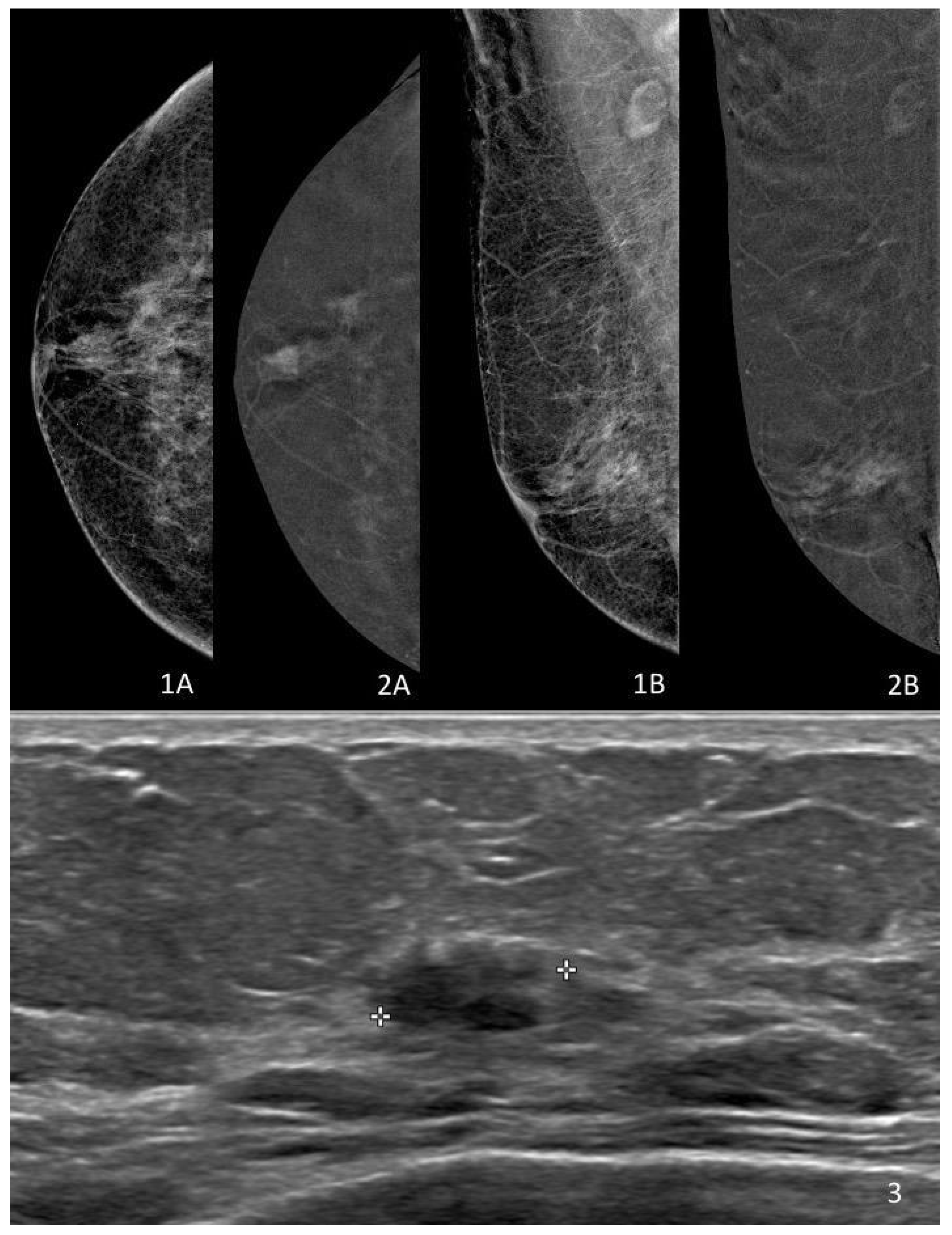 Imaging Ductal Carcinoma In Situ in the Era of De-Escalation: Role ...