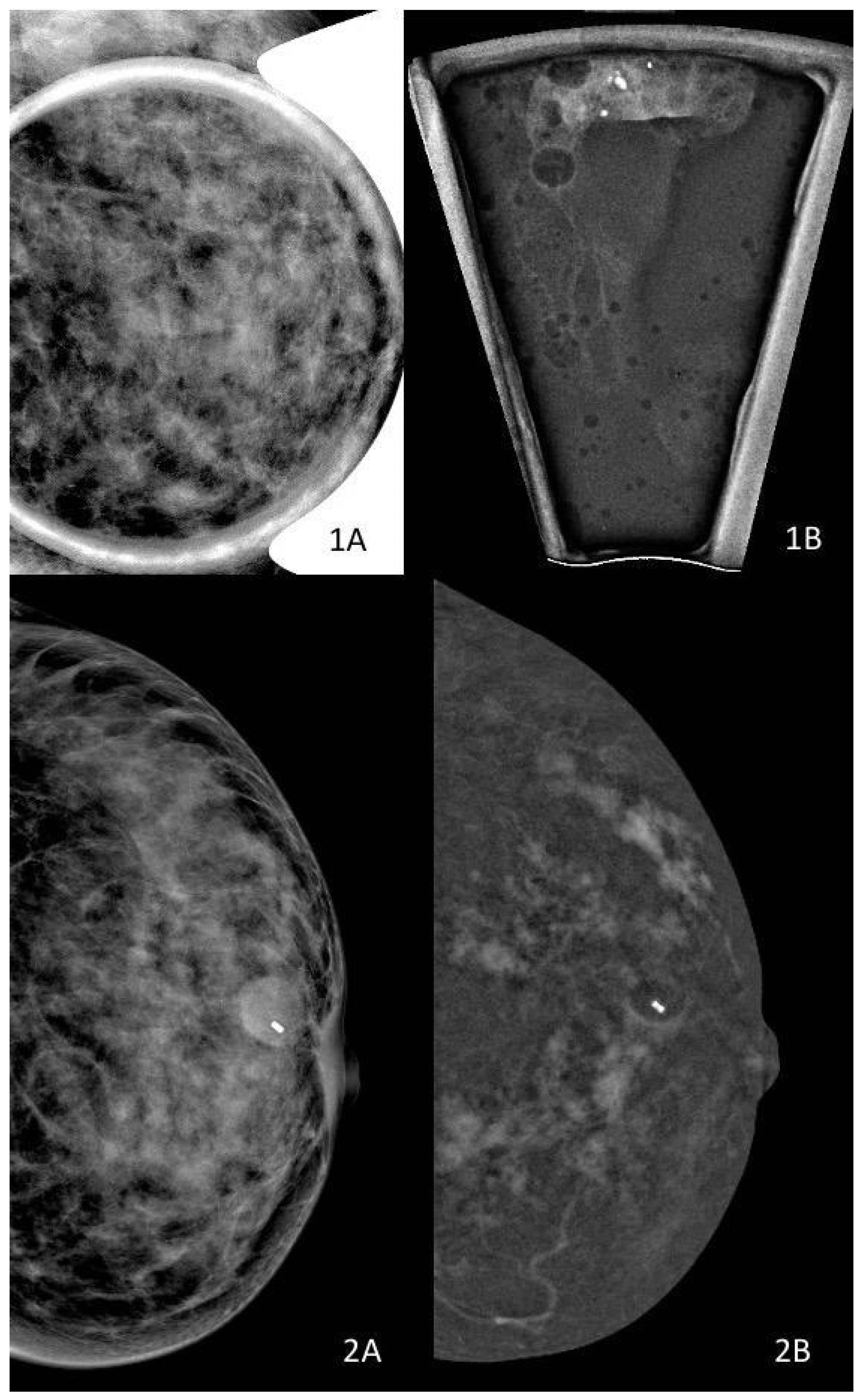 Imaging Ductal Carcinoma In Situ in the Era of De-Escalation: Role ...