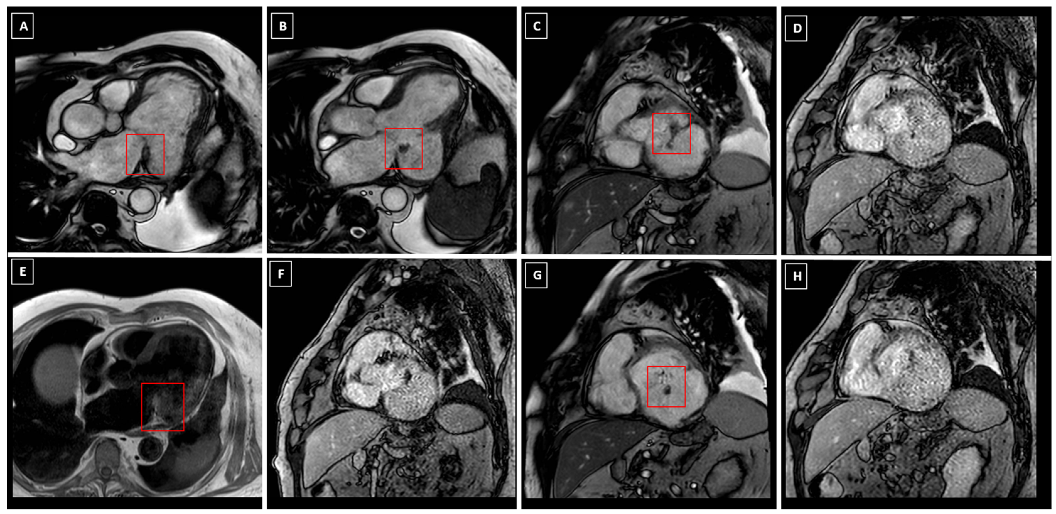 Caceous Rupture of Caseous Calcification of the Mitral Annulus: Pathophysiology ...