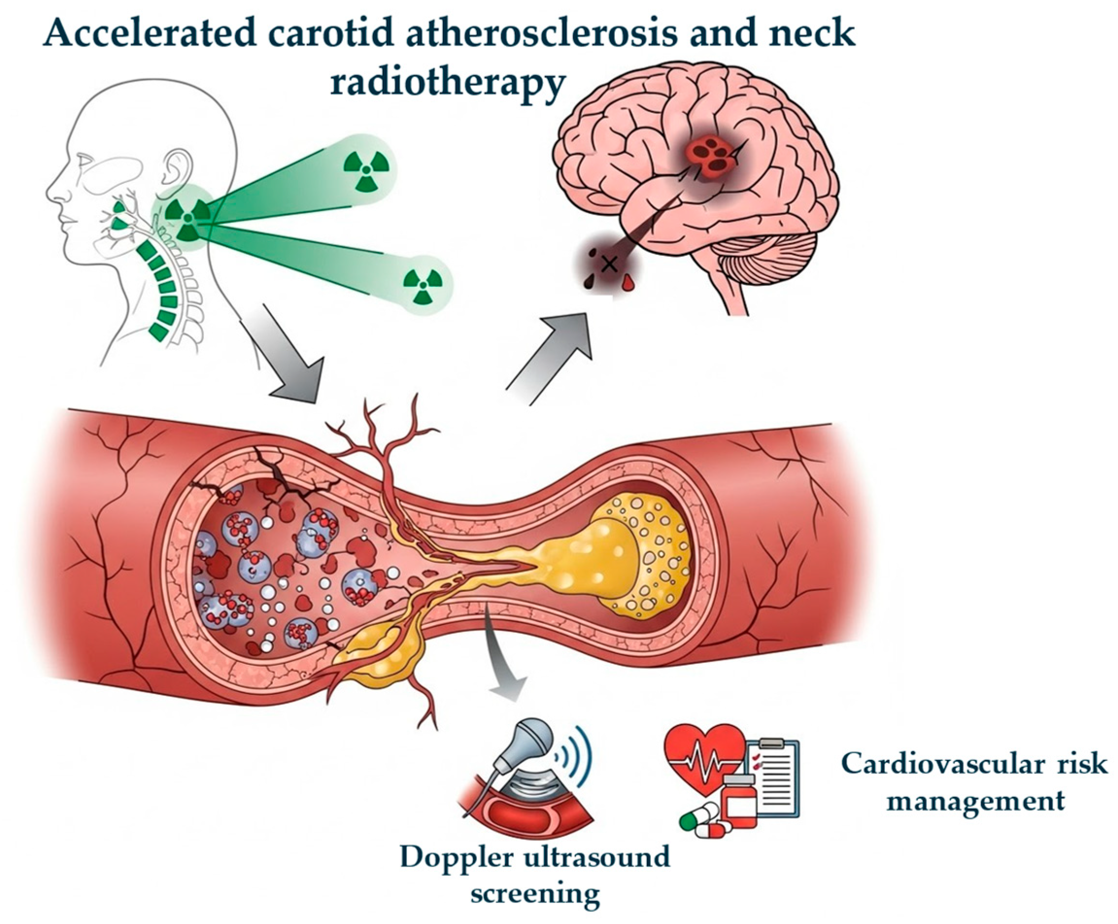 Radiation-Induced Carotid Artery Disease: Pathogenesis, Diagnosis and ...