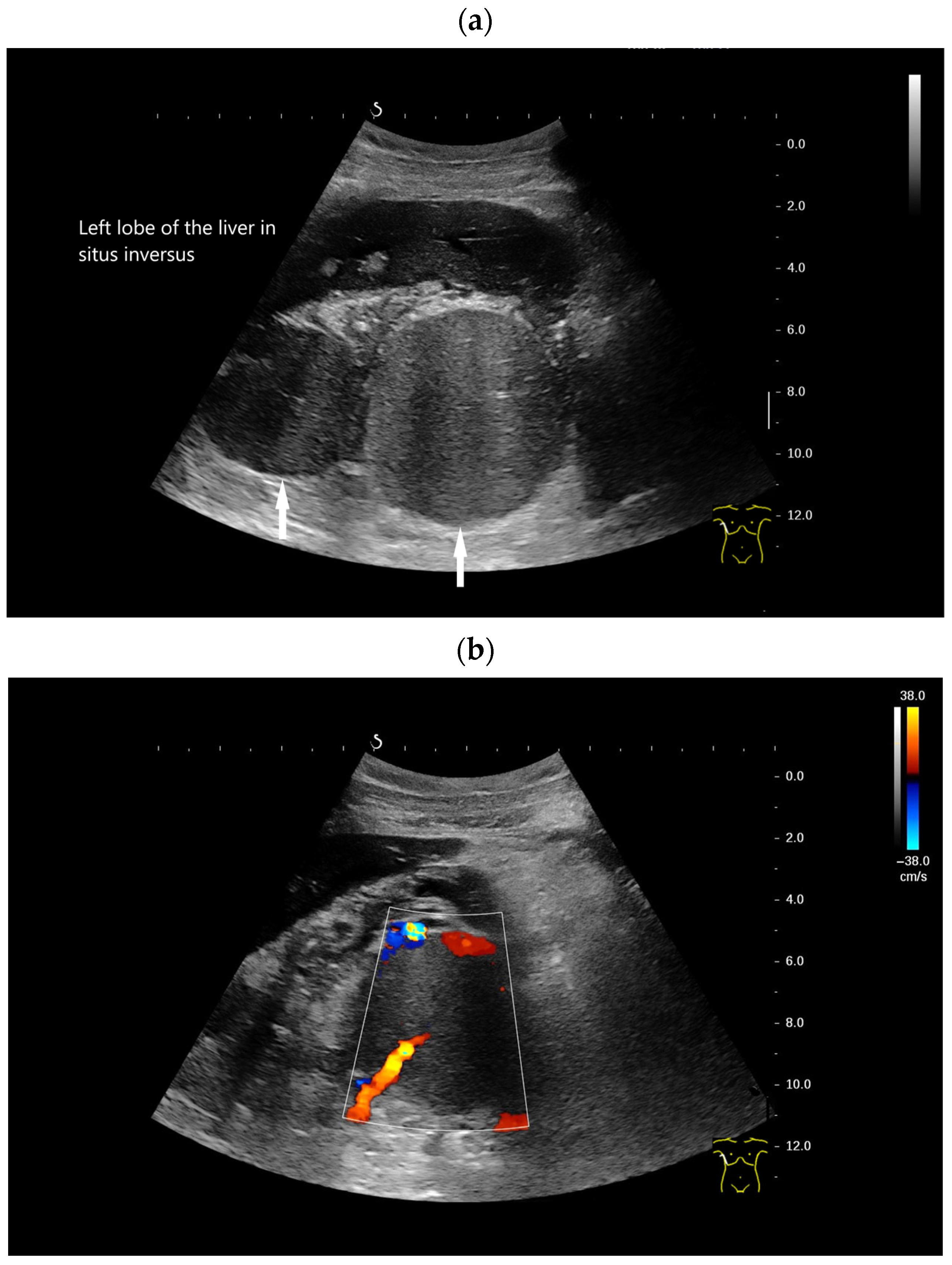 Splenoses and Other Ectopic and Heterotopic Splenic Tissue: The Use of ...