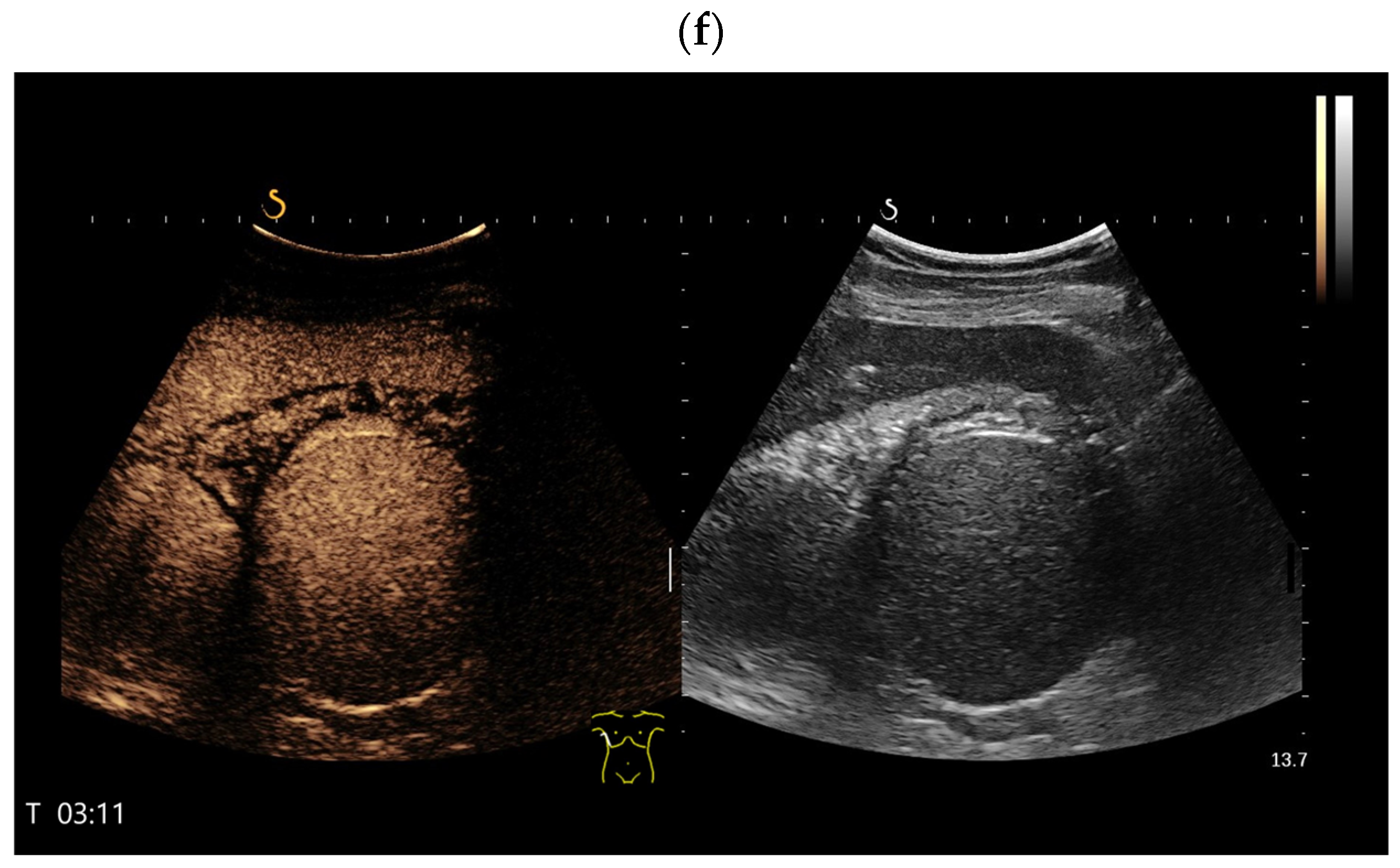 Splenoses and Other Ectopic and Heterotopic Splenic Tissue: The Use of ...