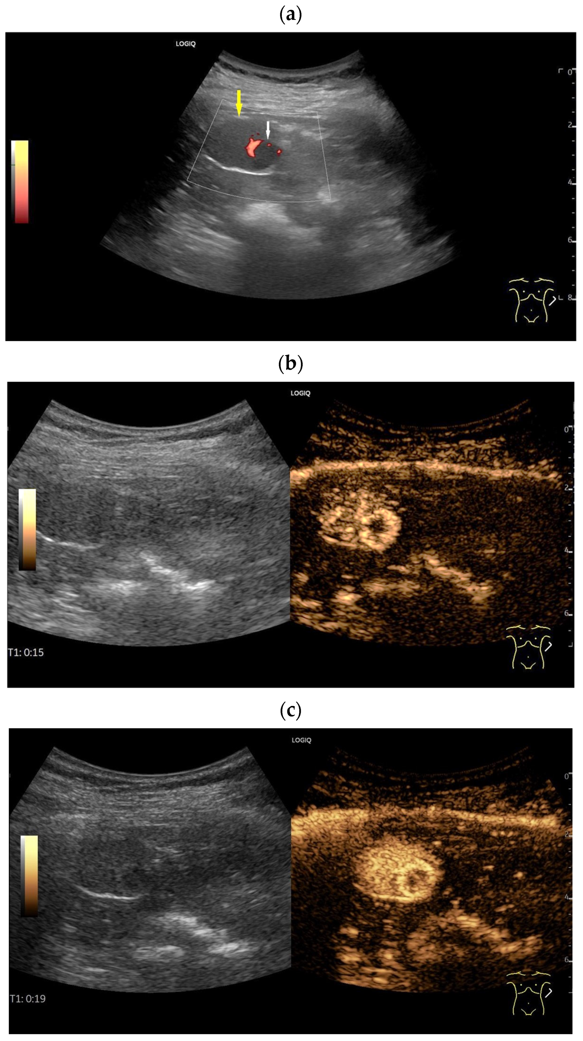 Splenoses and Other Ectopic and Heterotopic Splenic Tissue: The Use of ...