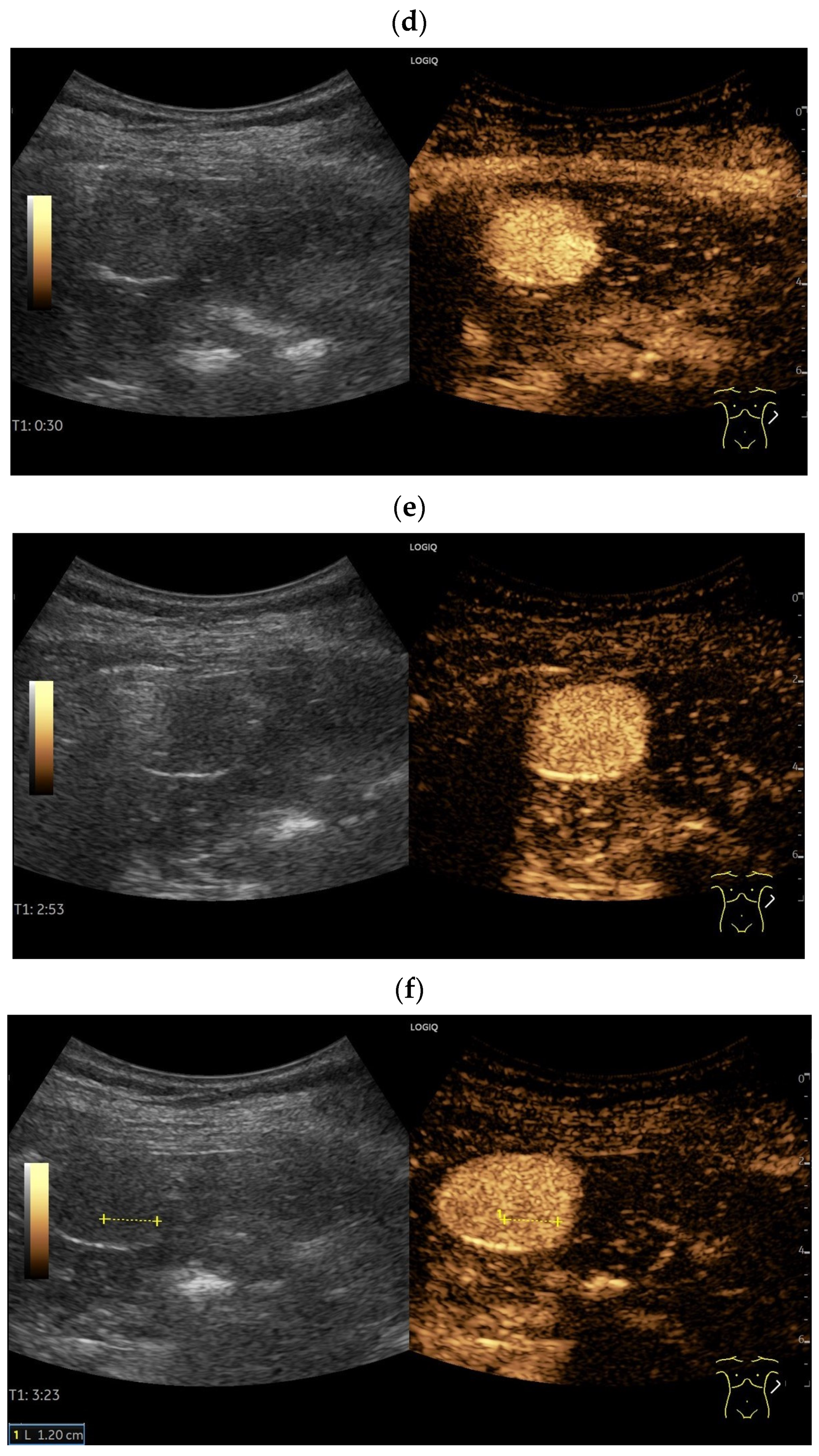 Splenoses and Other Ectopic and Heterotopic Splenic Tissue: The Use of ...
