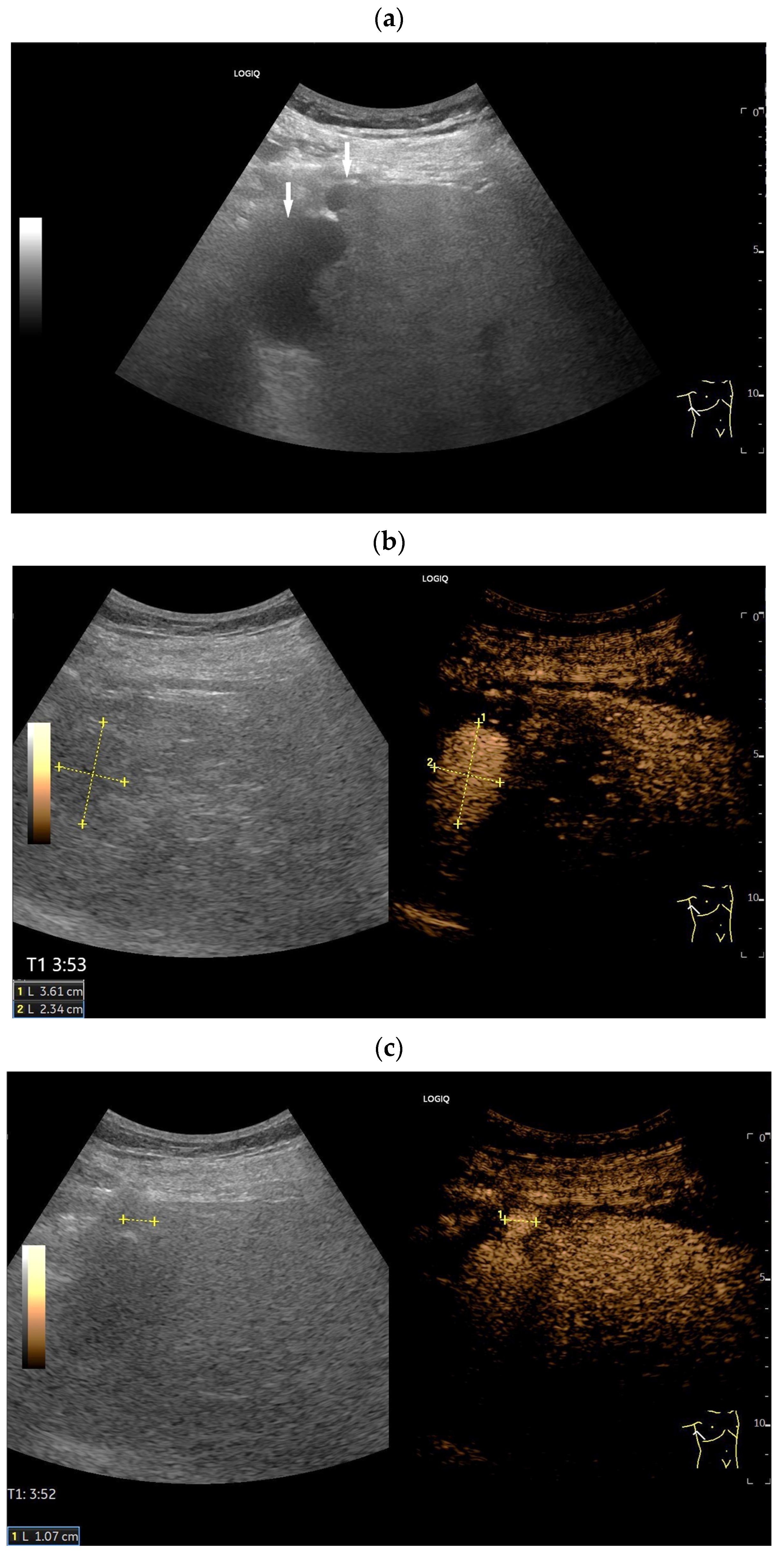 Splenoses and Other Ectopic and Heterotopic Splenic Tissue: The Use of ...