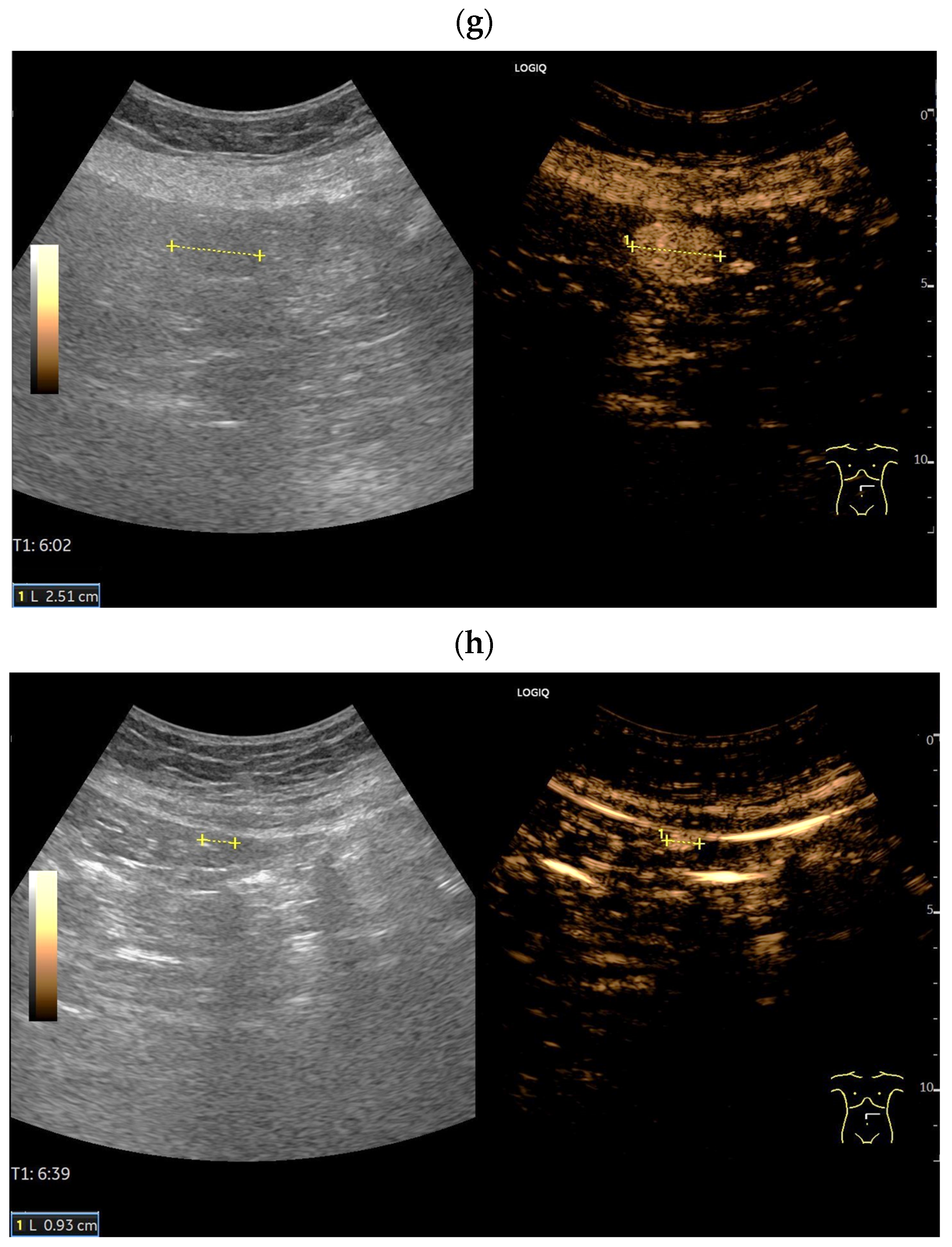 Splenoses and Other Ectopic and Heterotopic Splenic Tissue: The Use of ...