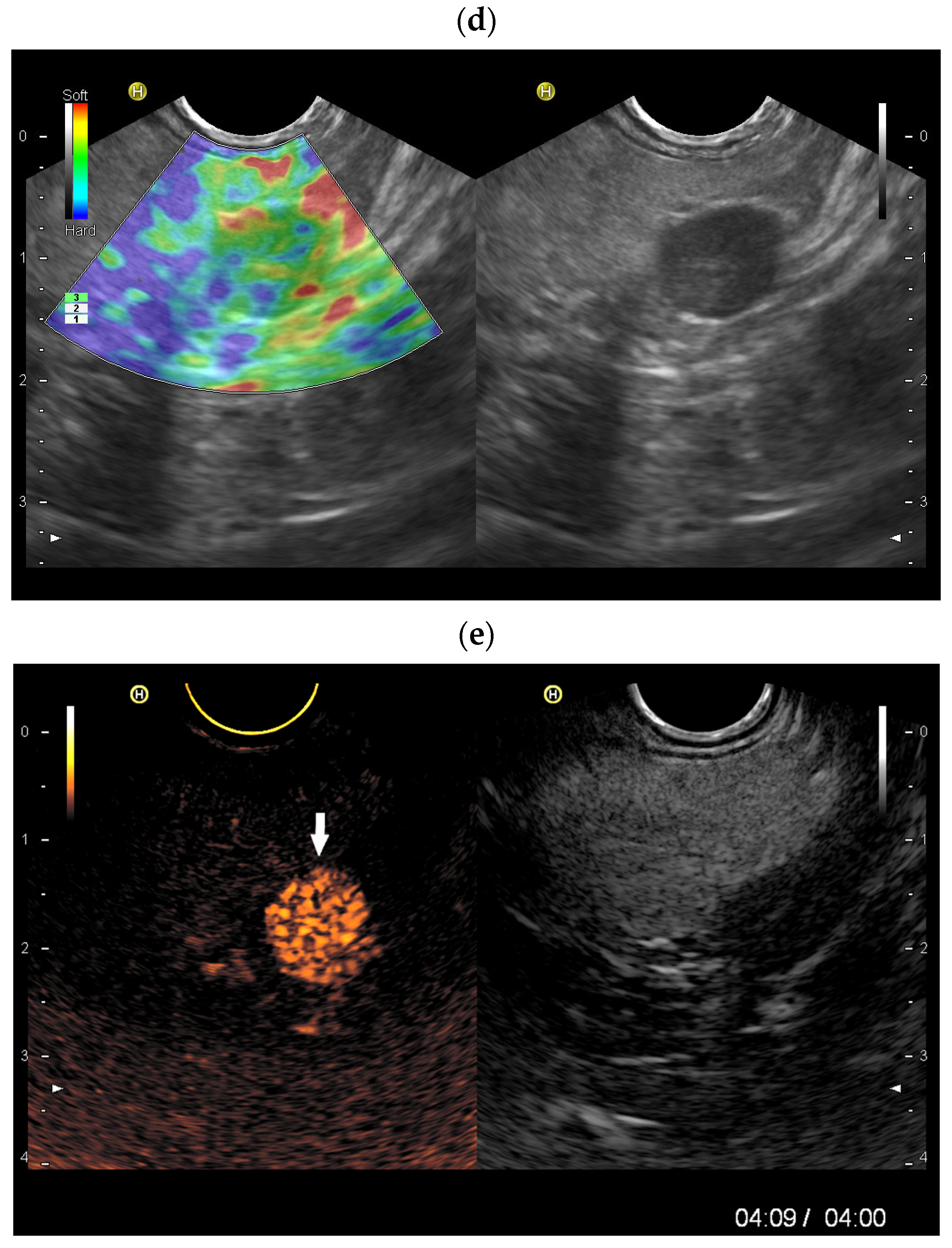 Splenoses and Other Ectopic and Heterotopic Splenic Tissue: The Use of ...