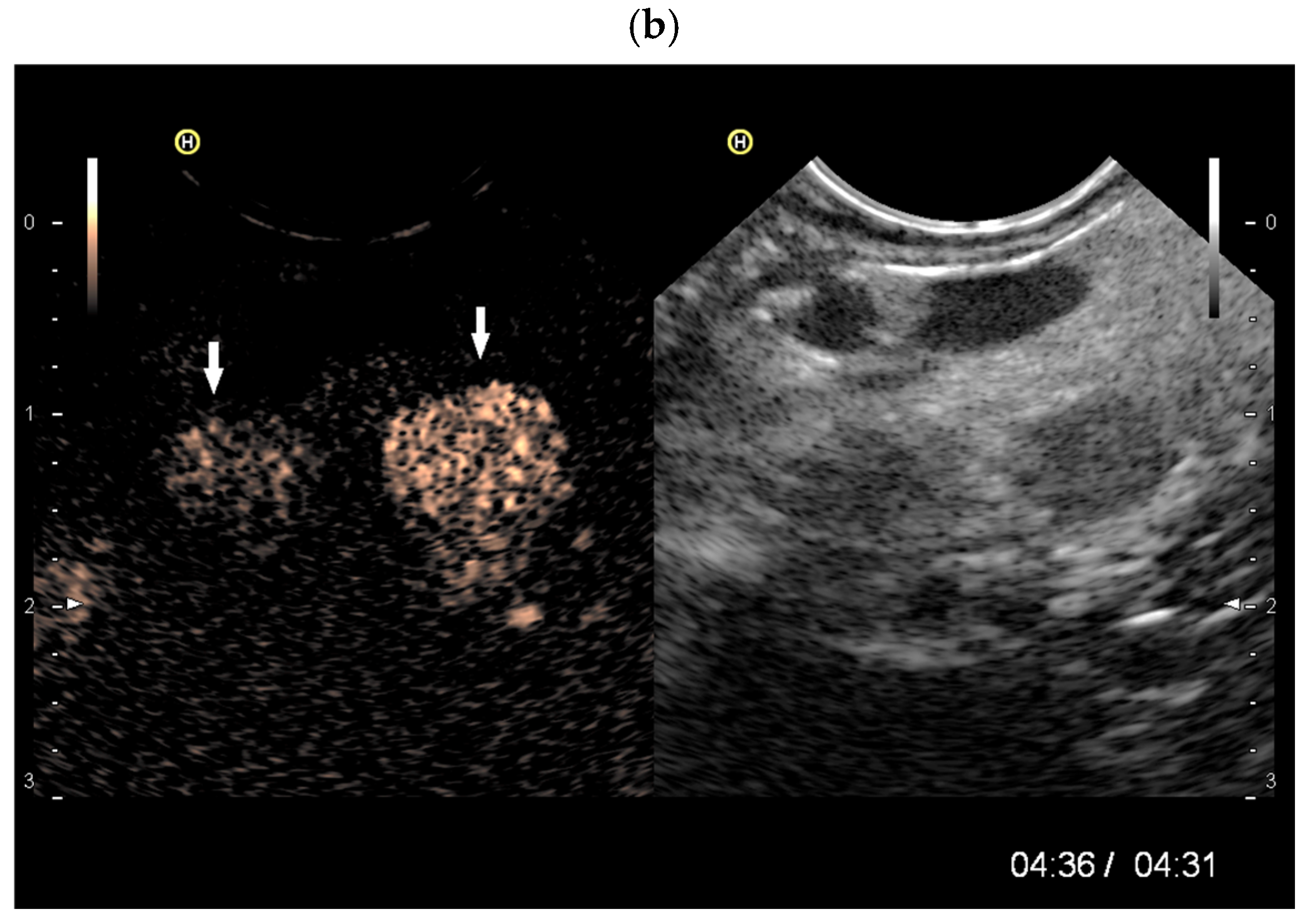 Splenoses and Other Ectopic and Heterotopic Splenic Tissue: The Use of ...