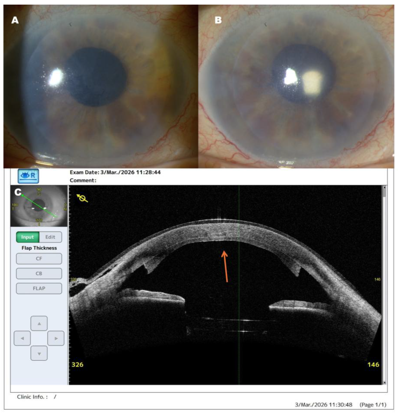 Multiplanar AS-OCT Detection of Clinically Occult Posterior Gas Bubble ...