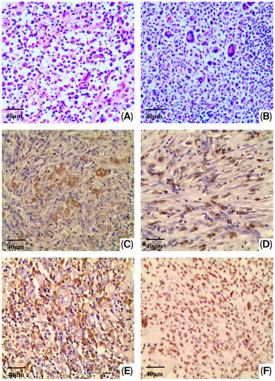 Differential Expression of Apoptosis-Stimulating Proteins of p53 (ASPPs) Between Langerhans Cell Histiocytosis and Langerhans Cell Sarcoma