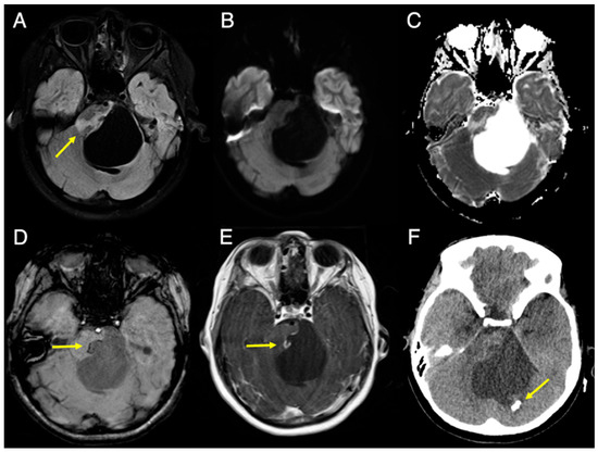 Cerebroretinal Microangiopathy with Calcifications and Cysts (CRMCC): A 5-Year Diagnostic Challenge