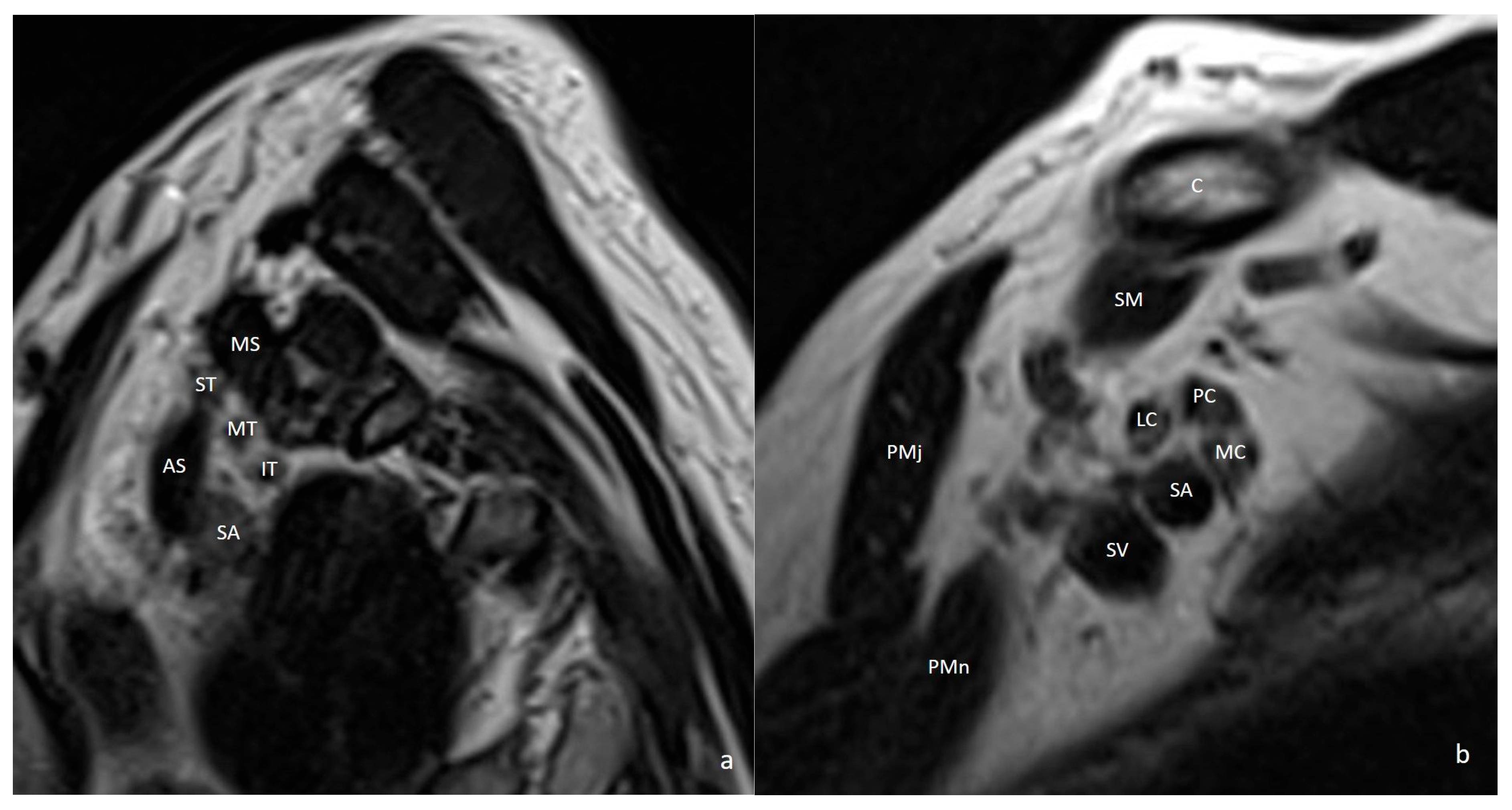 Multimodality Imaging of Thoracic Outlet Syndrome: Etiological and ...