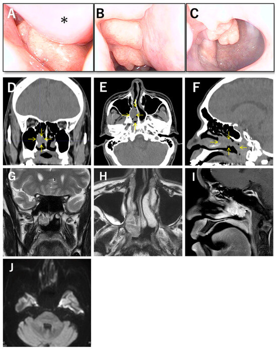 Seromucinous Hamartoma of the Nasal Cavity: A Rare Entity Presenting a Diagnostic Challenge in Preoperative Biopsy