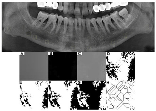 Evaluation of Mandibular Trabecular Microarchitecture in Stafne Bone Cavity: A Pilot Study