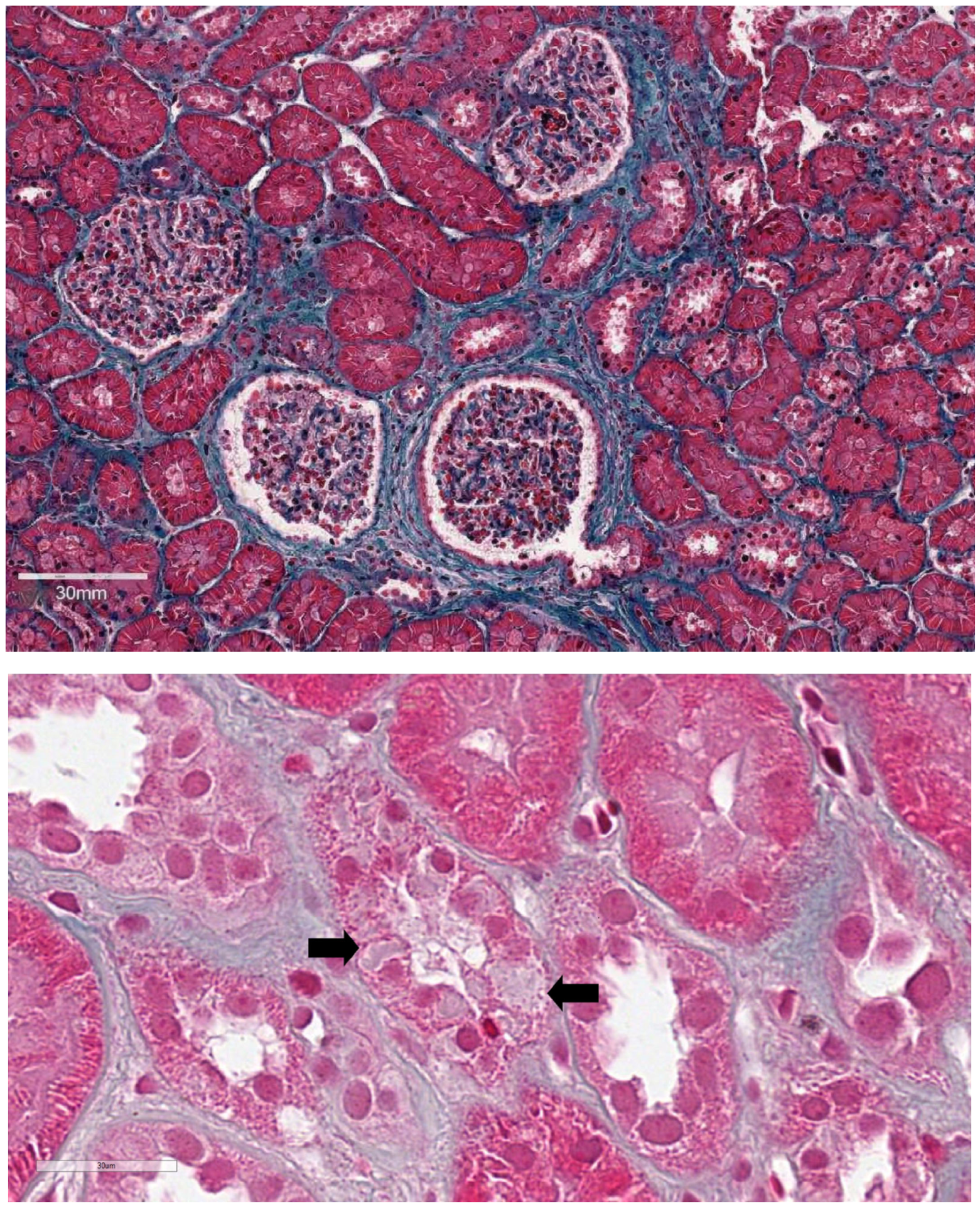 Autosomal Dominant Tubulointerstitial Kidney Disease—UMOD: Case Report ...