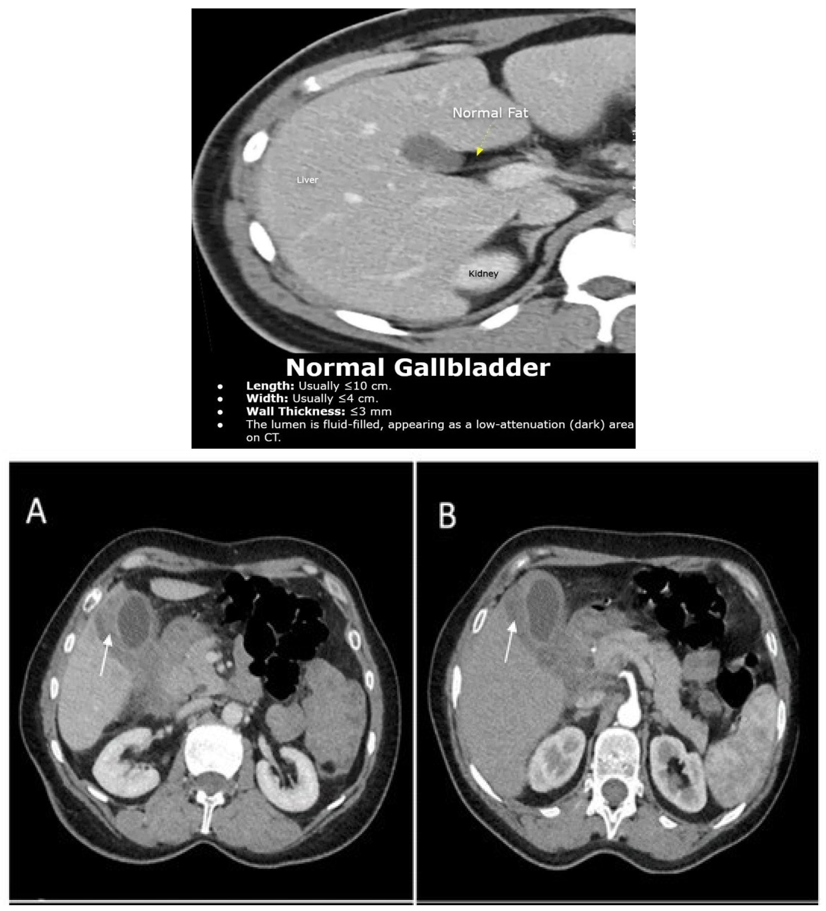 Clinical and Molecular Signatures of Gallbladder Lesions: Insights into ...