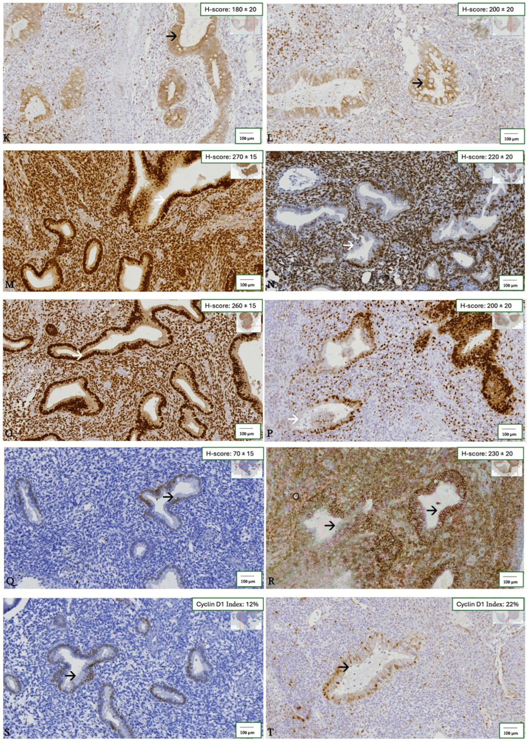 Context-Dependent Alterations of E-Cadherin, β-Catenin, and Vimentin in ...