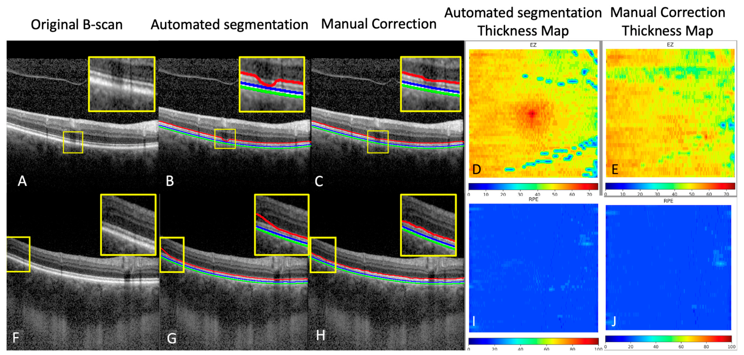 Inner Rpe Deep Learning-Based Automated Segmentation and Quantification of the ...