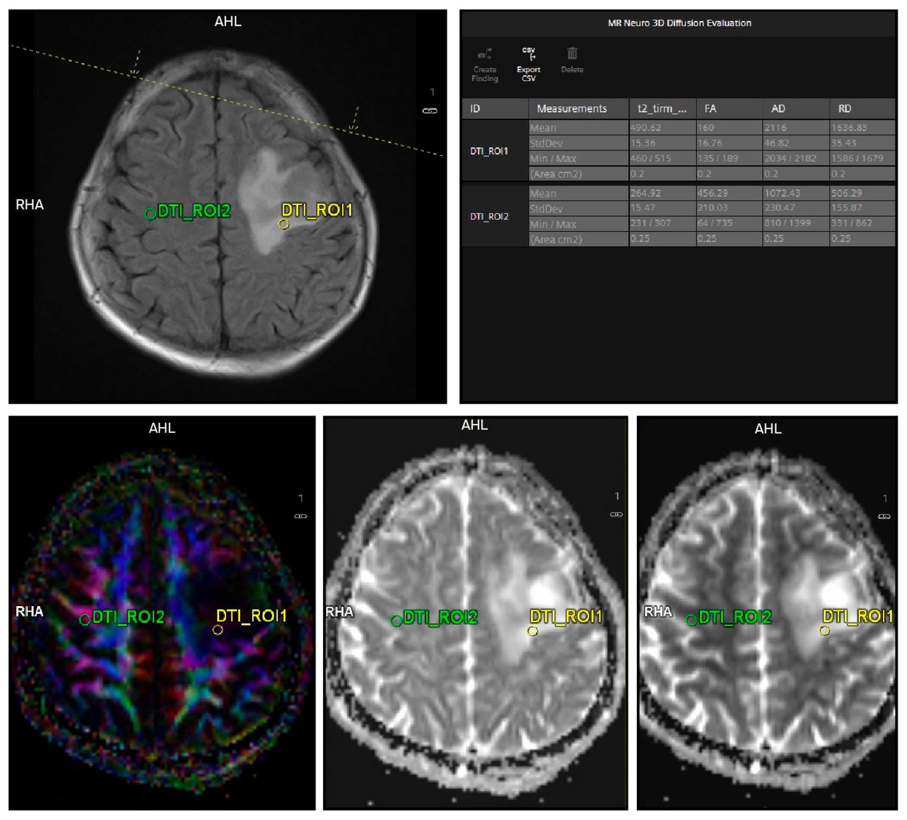 Perilesional Diffusion Tensor Imaging for Differentiating Malignant and ...
