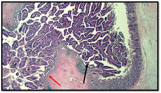 Mucinous adenocarcinoma of the appendix (MACA). a High-grade atypia and...  | Download Scientific Diagram