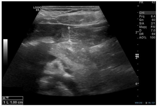 Pyloric Stenosis Abs