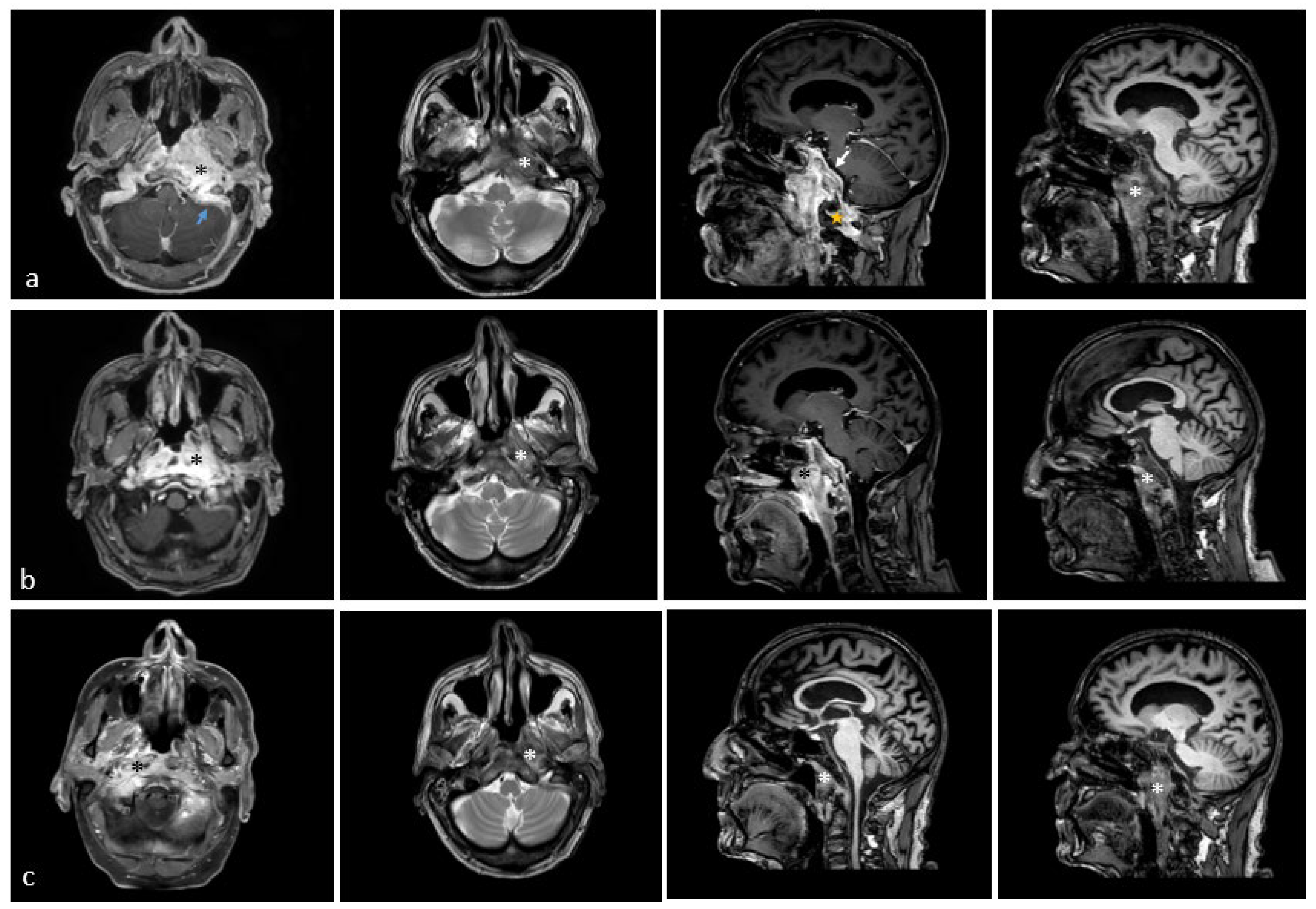 Atypical Skull Base Osteomyelitis of the Clivus Mimicking a Malignant ...