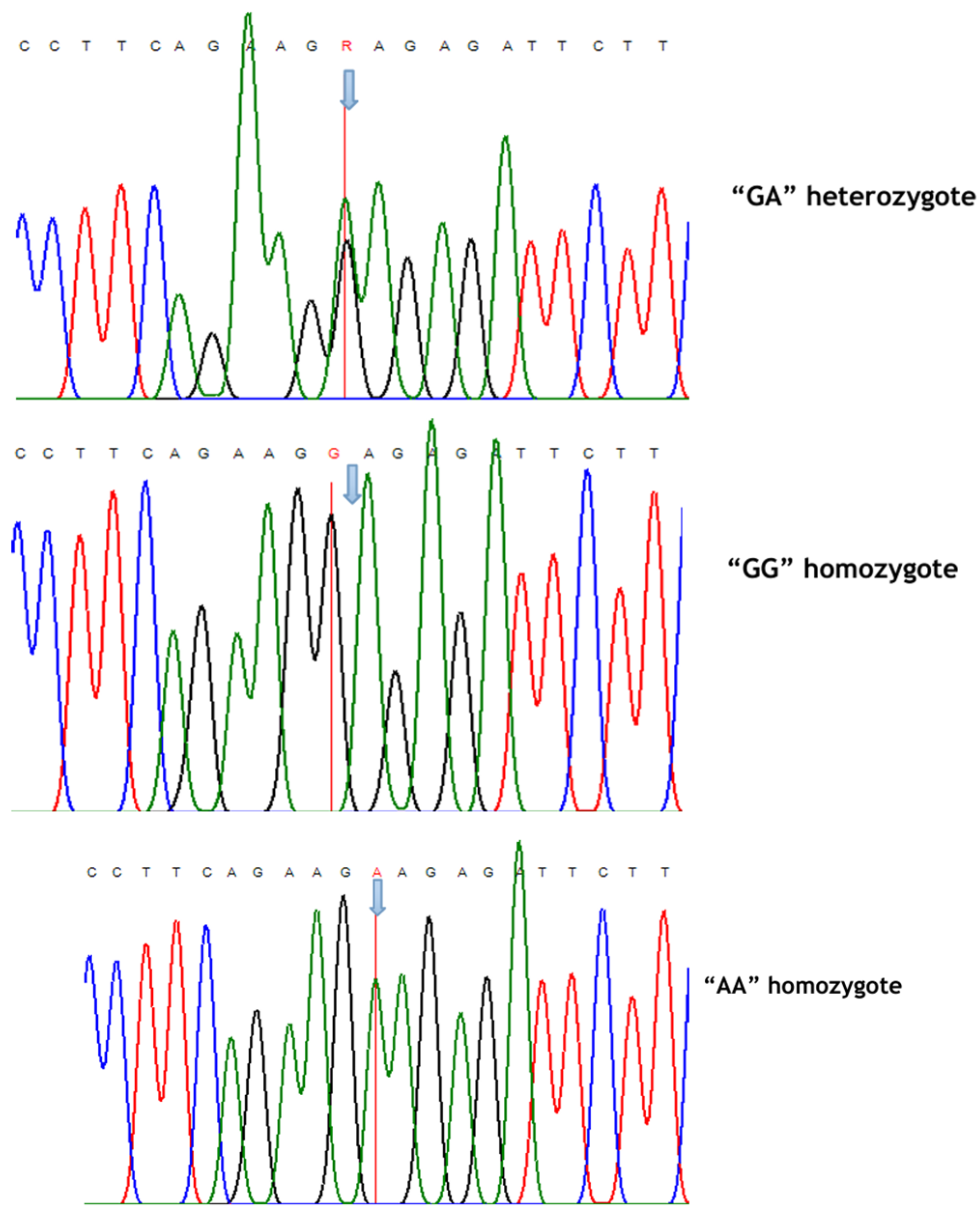 Impact of Gene Polymorphism rs2275913 and Serum IL-17A Levels on Liver ...
