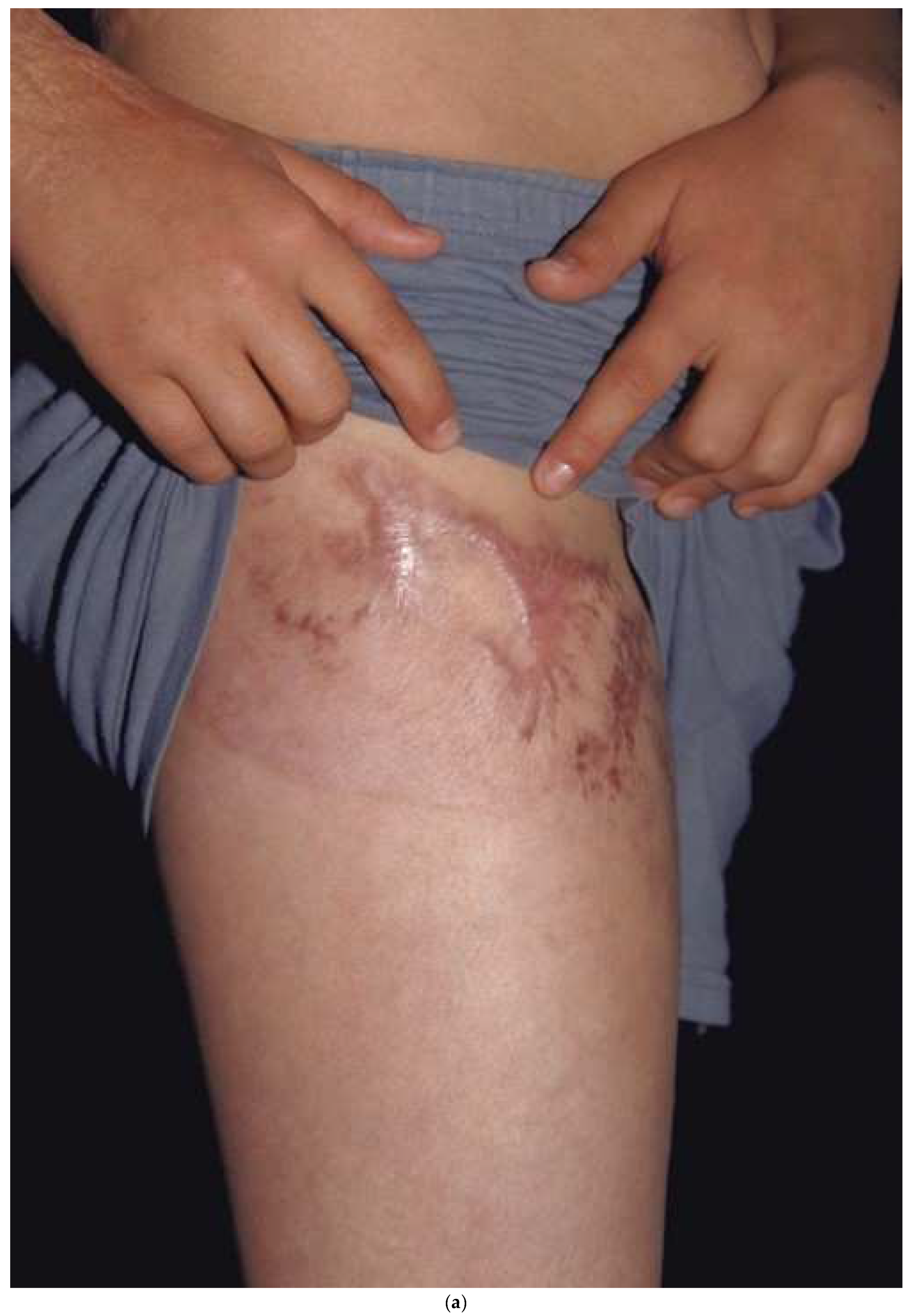 a) Burn scars on the bilateral lower extremities before treatment