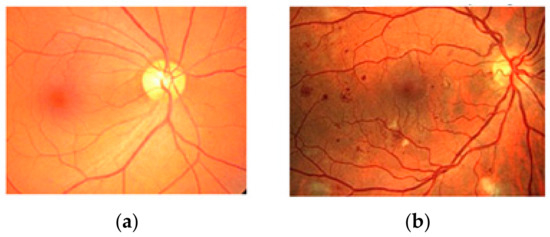 Accelerating Retinal Fundus Image Classification Using Artificial ...